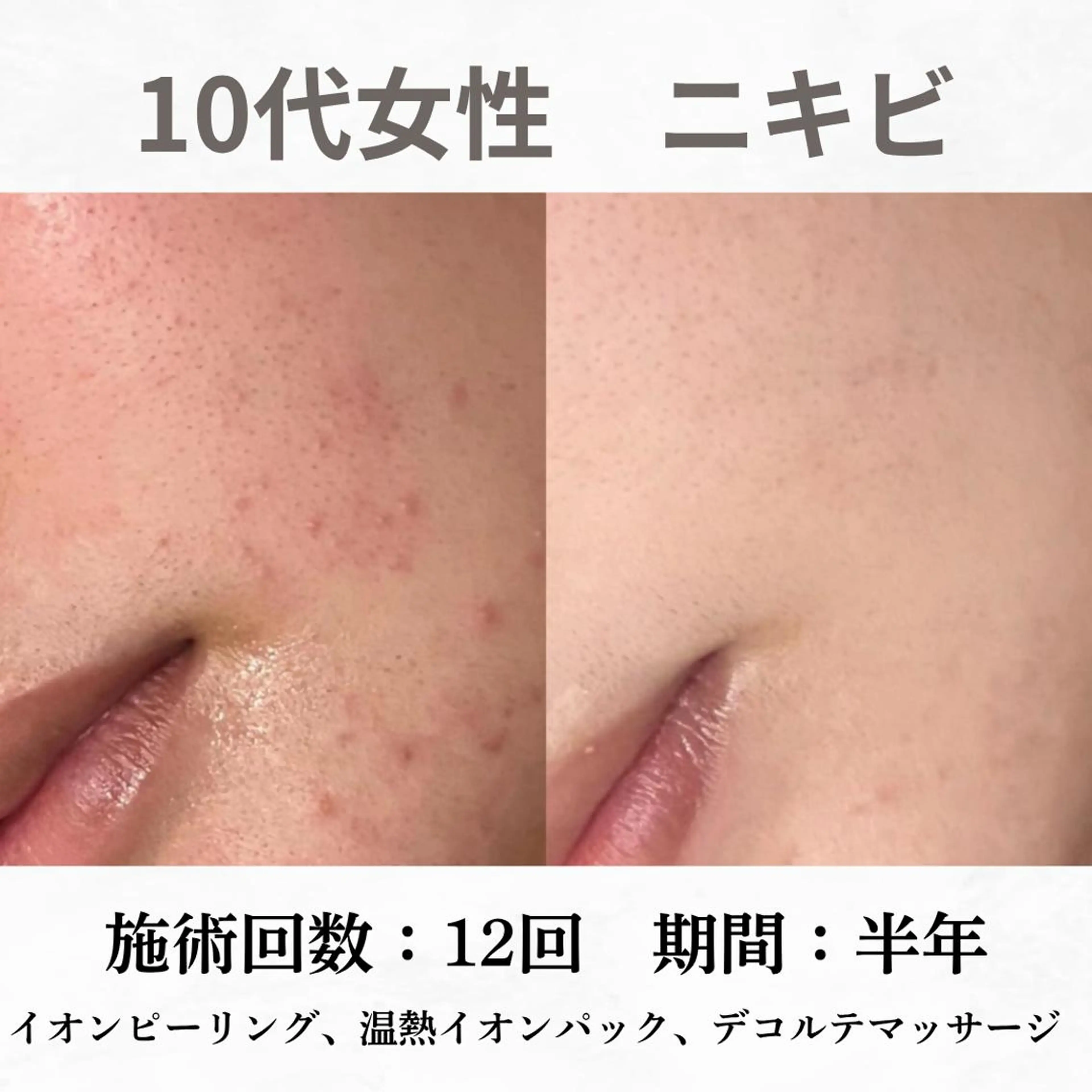 重度ニキビ専門🌷 ダウンタイムなしのエステ・リラクイメージ