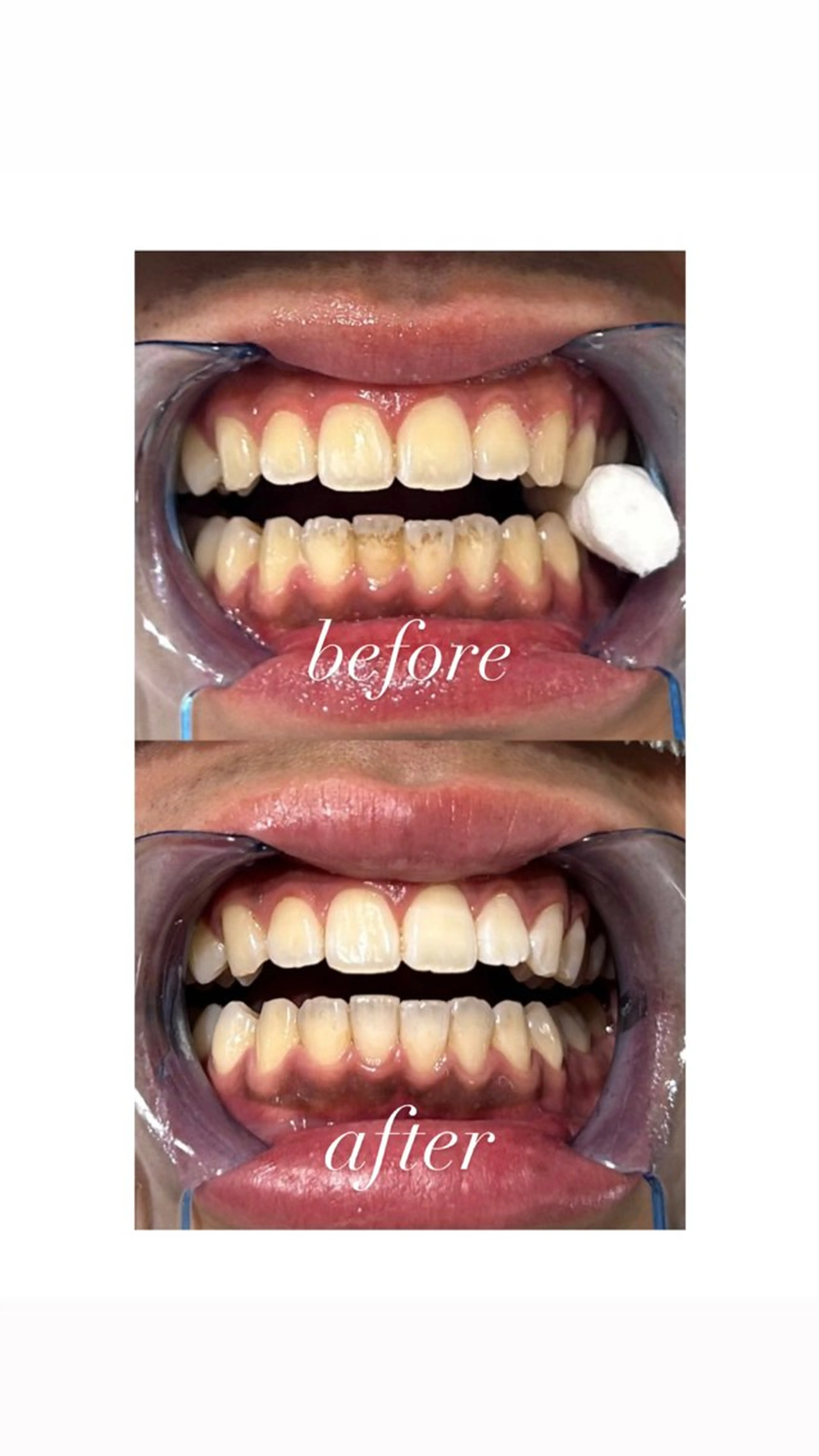 ホワイトニング通い放題1ヶ月の写真