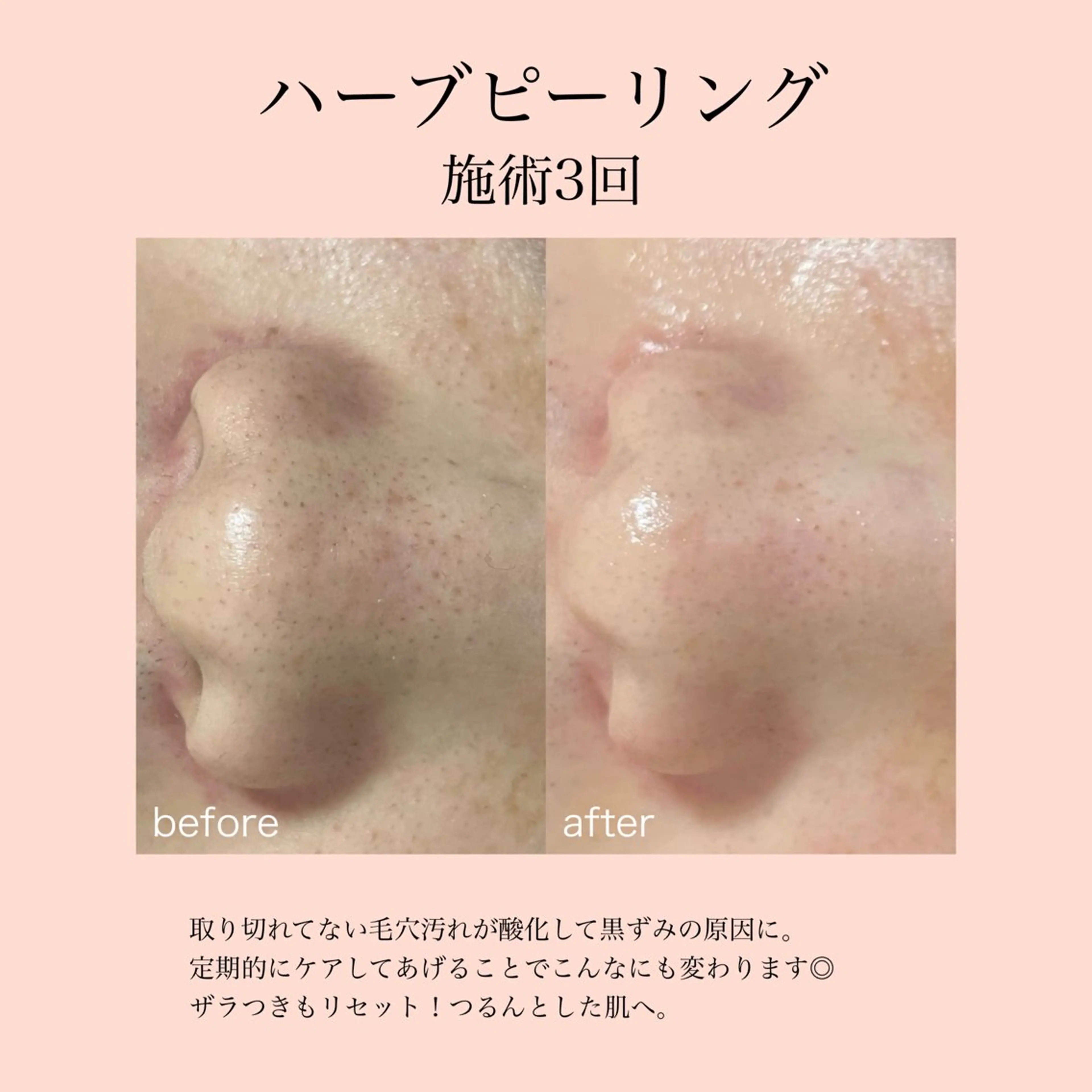 ミニモ限定価格【ニキビ/ザラつきにはこれ】ハーブピーリングの写真