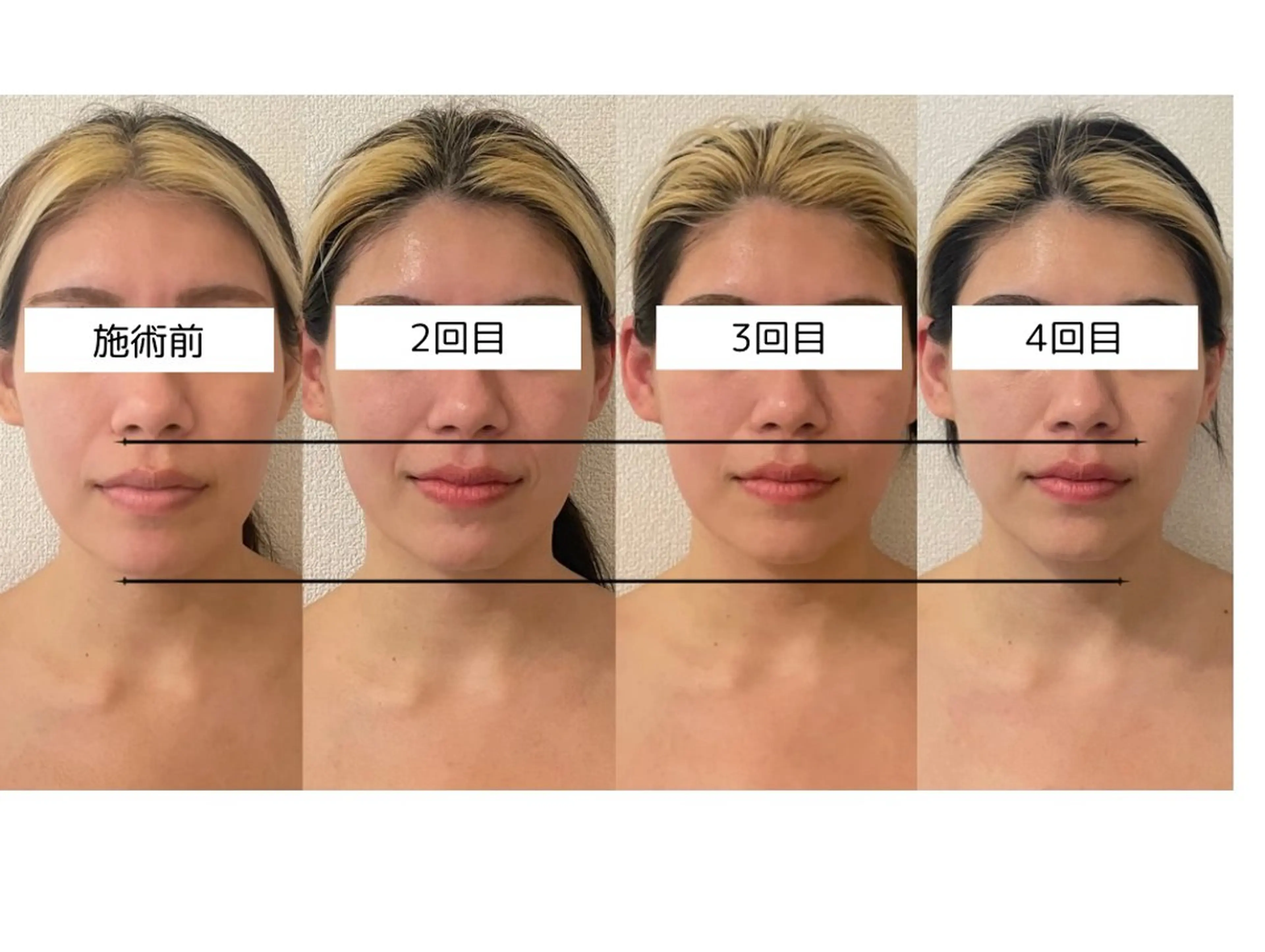 エステ 小顔/たるみ/黒ずみ除去専門サロン/SONA 大和西大寺店所属・【小顔専門看護師 サロンSONA】のエステ・リラクイメージ