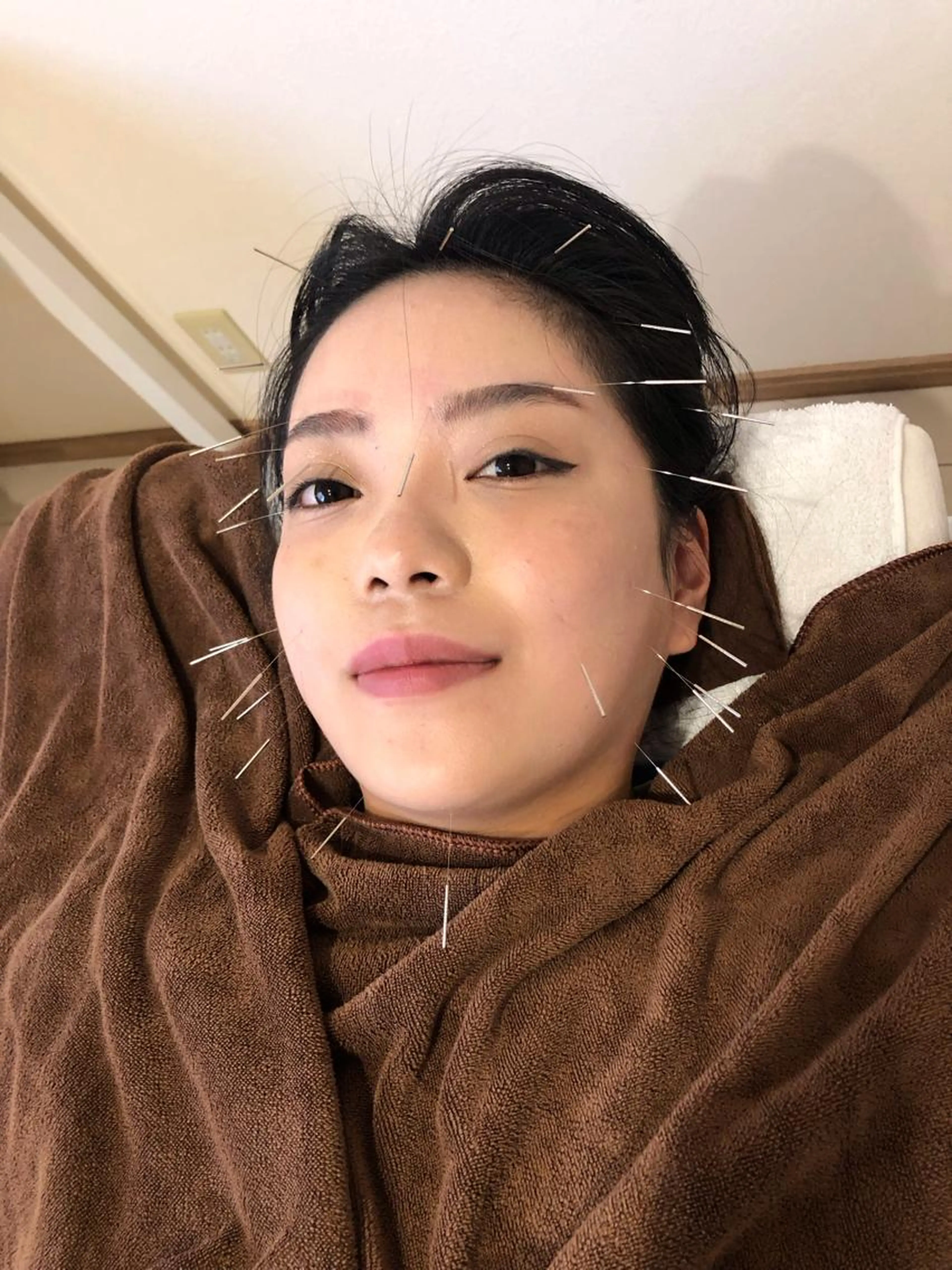 皆やってる😆NO2 美容鍼✨+ヘッドマッサージ👍の写真