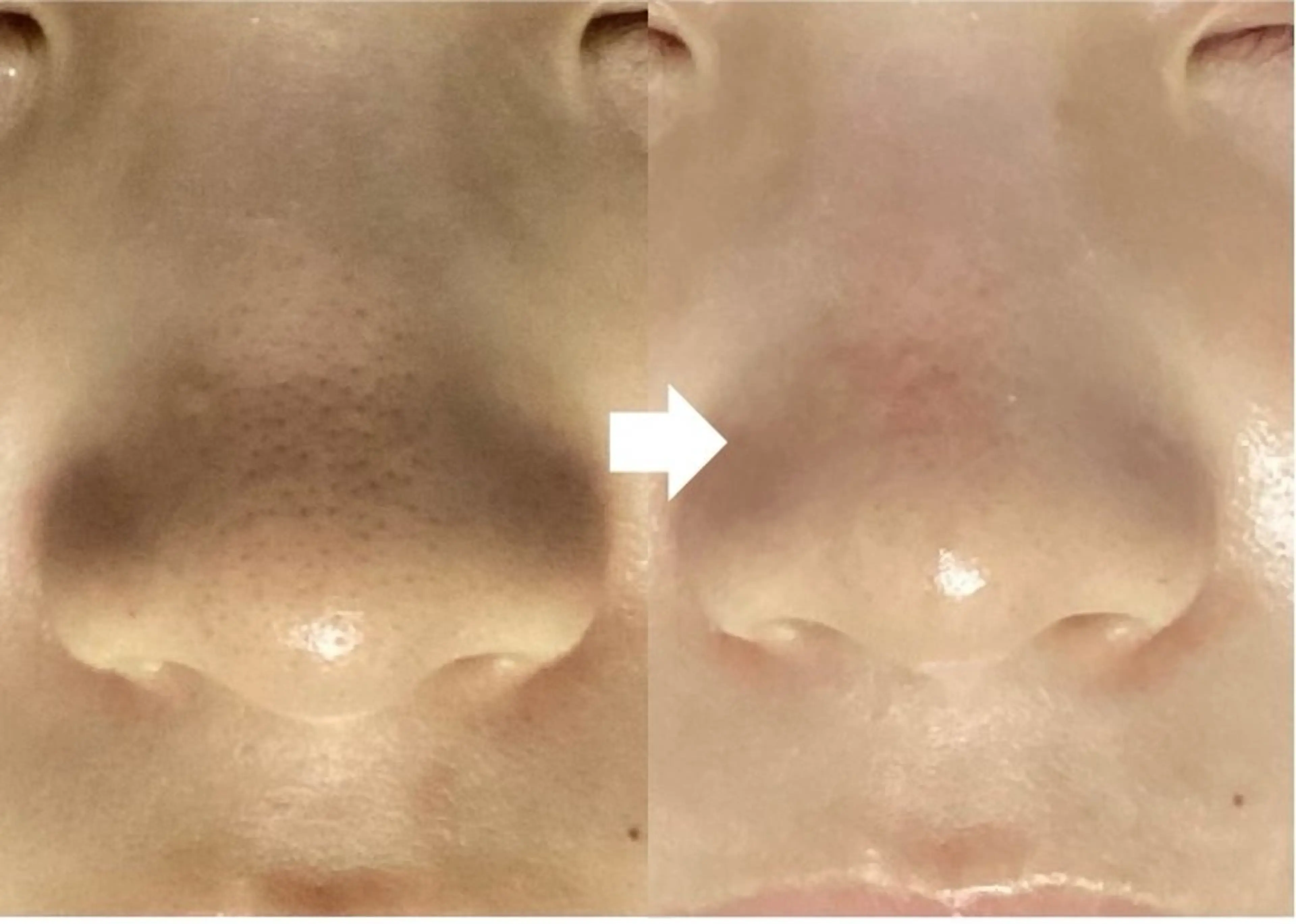 エステ 池袋ニキビ毛穴改善 🌿ハーブピーリングのエステ・リラクイメージ