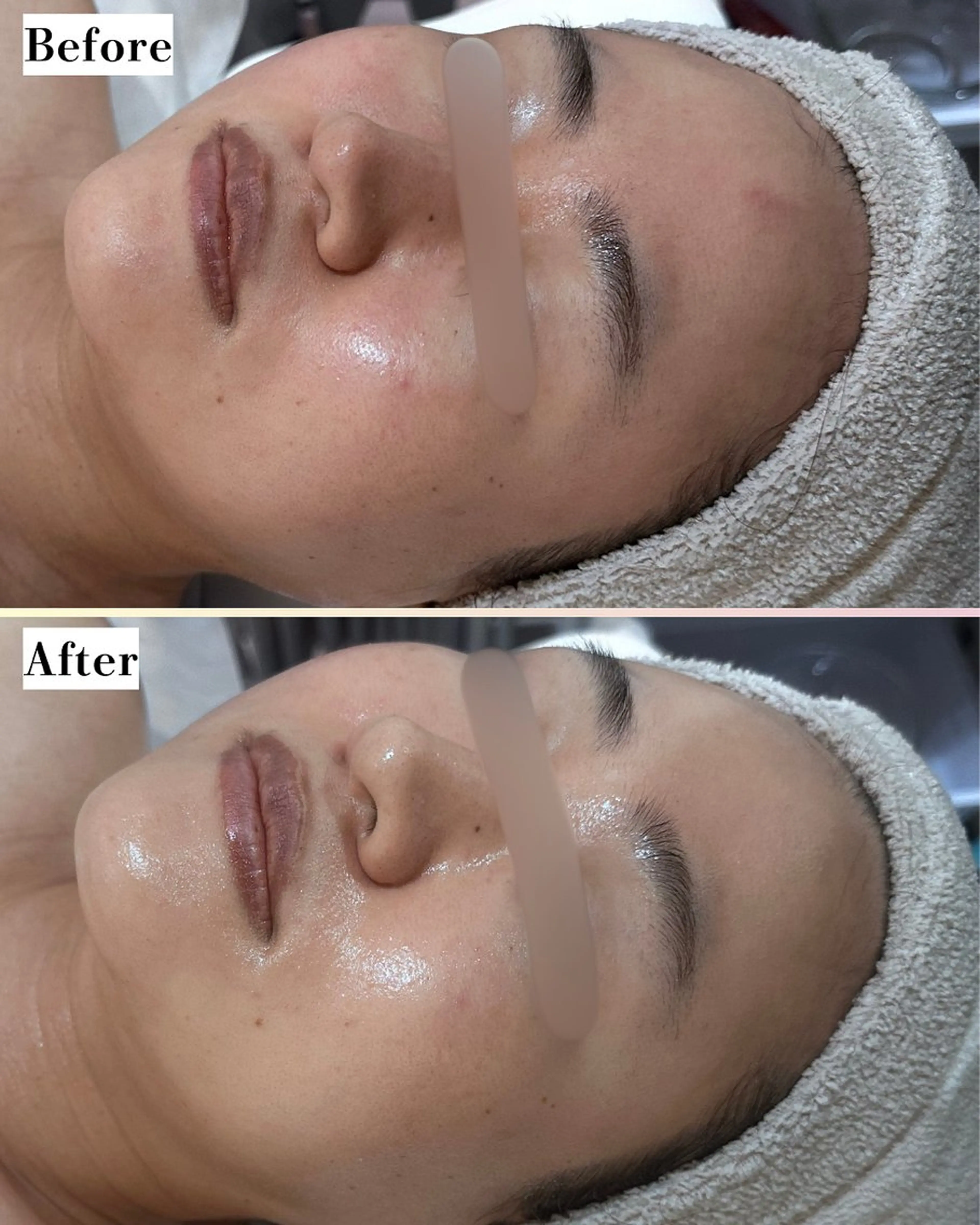 エステ |ピーリング・毛穴| soina神楽坂のエステ・リラクイメージ