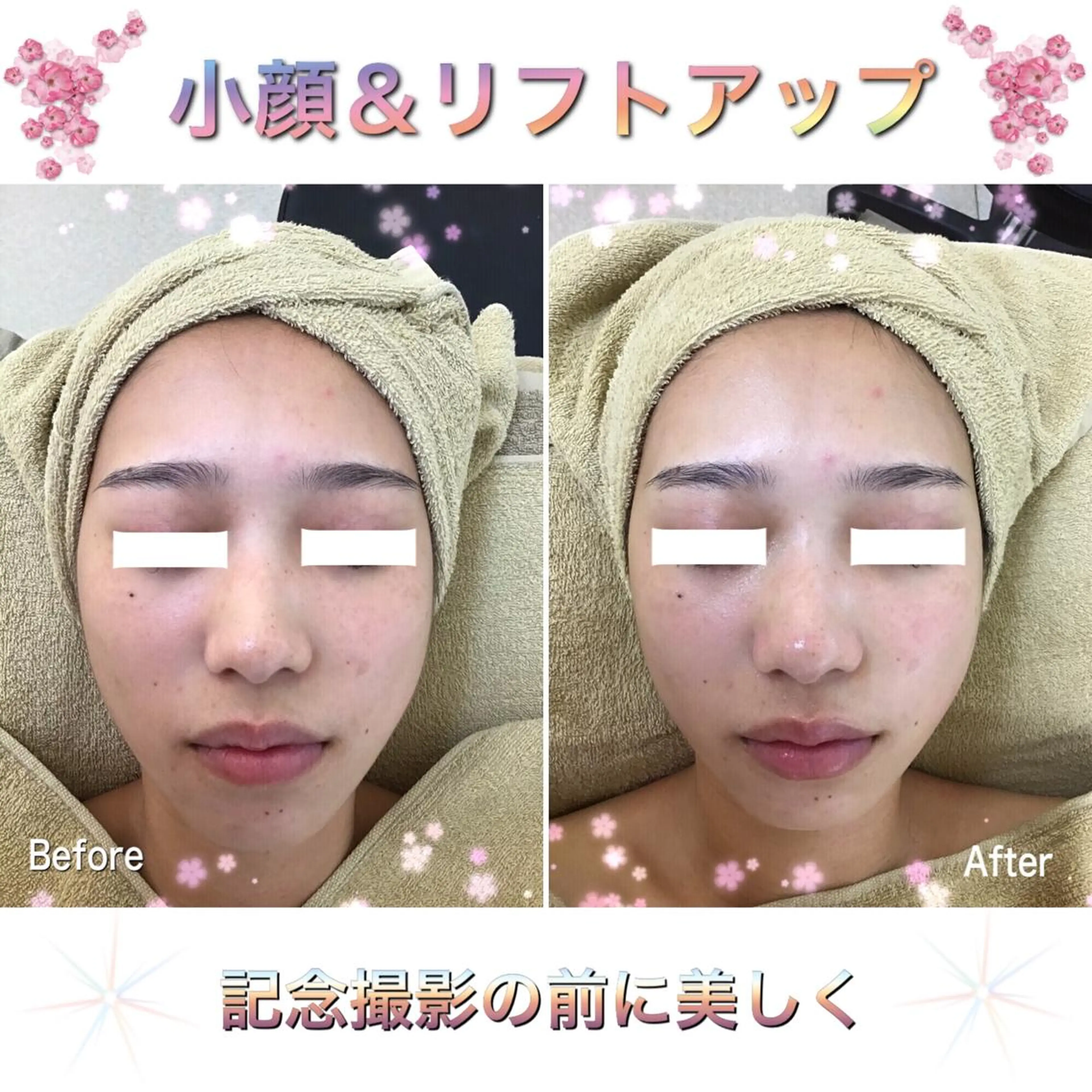 【小顔＆リフトアップコース】リンパ+コルギ+超音波+ハンドマッサージ🌸20代​〜​50代の幅広い年齢層の方に人気🎉の写真