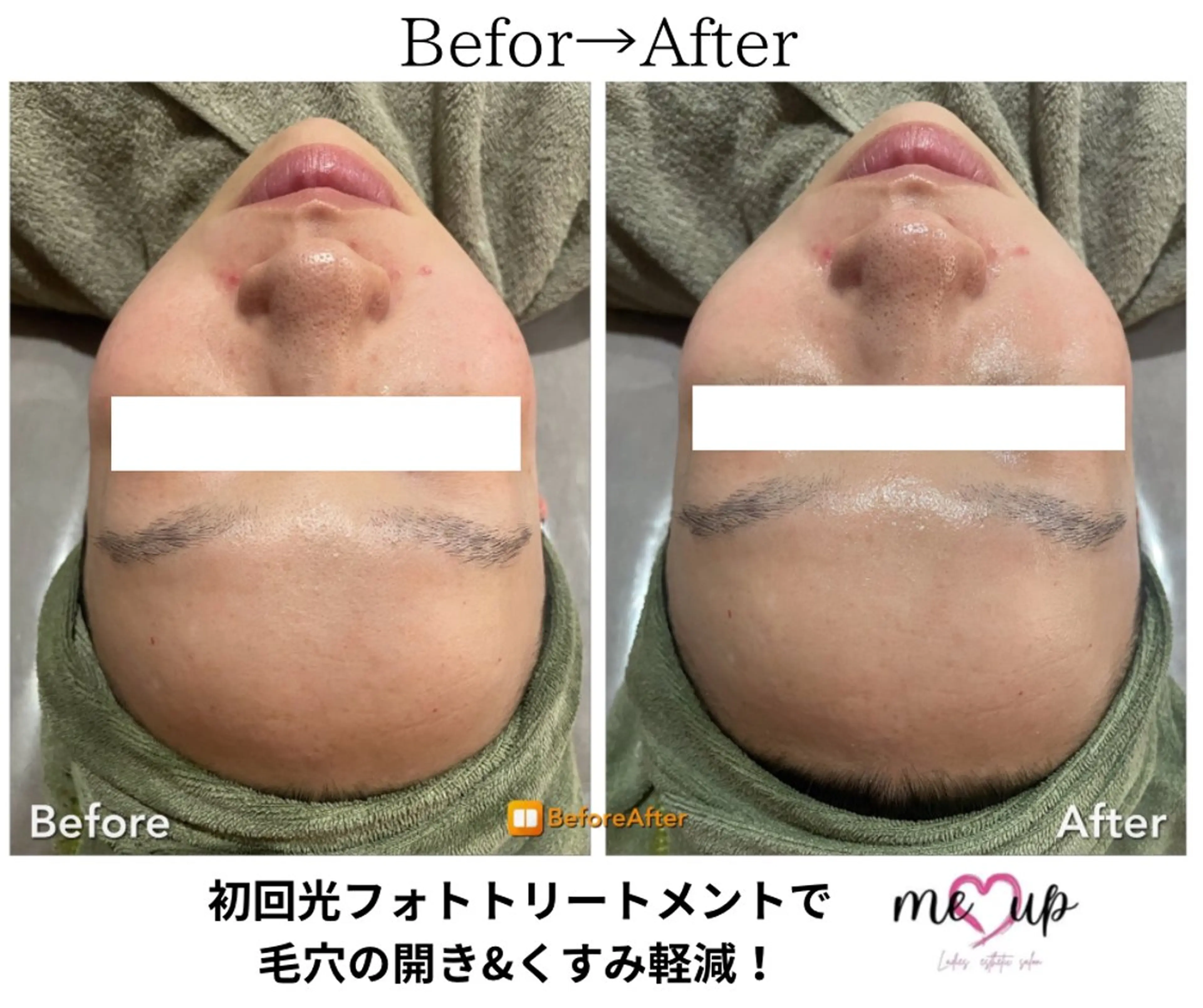 エステ Meupニキビ専門店 背中/ハーブ/肌管理のその他イメージ