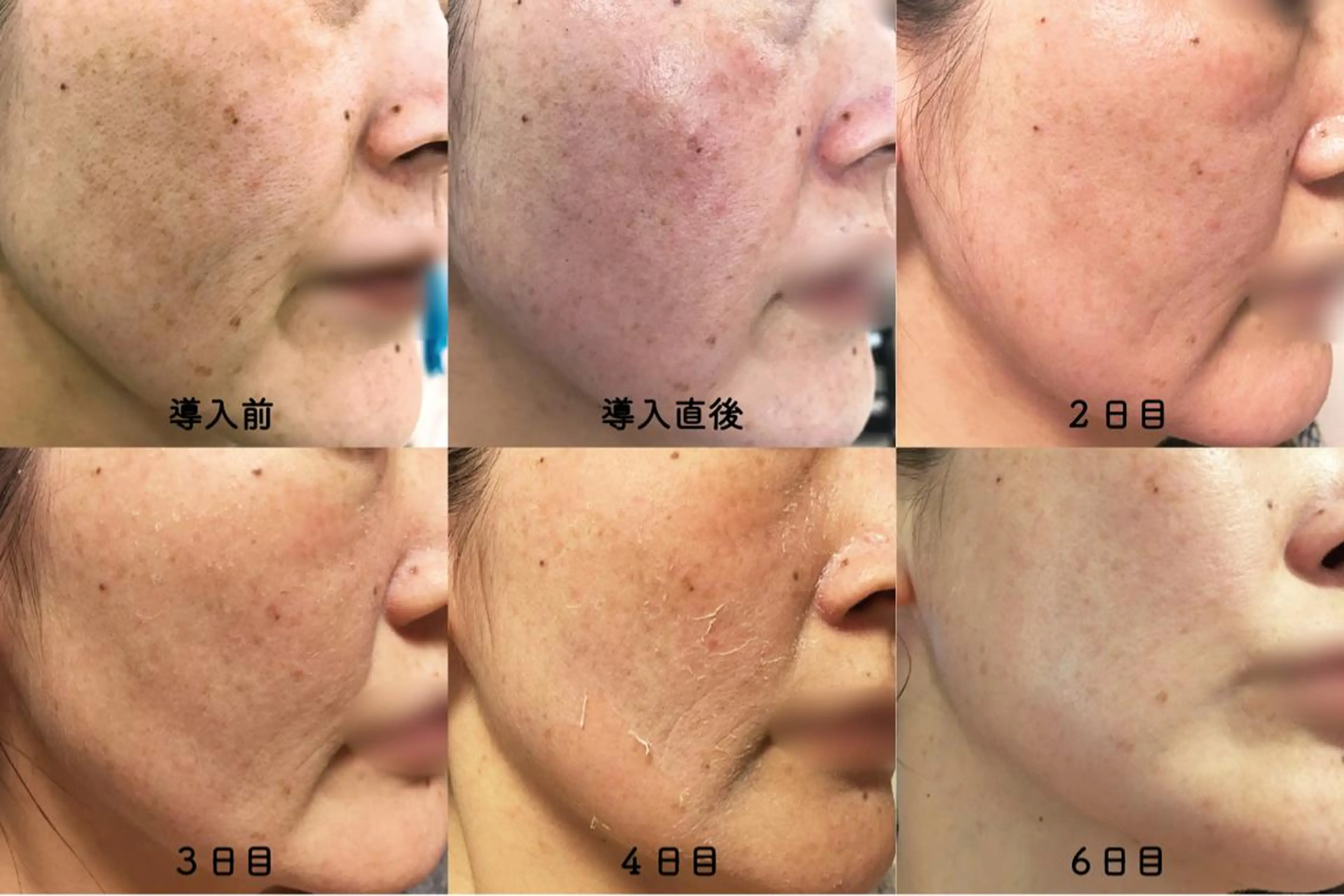 ニキビ&跡改善サロン オーナー光木のエステ・リラクイメージ