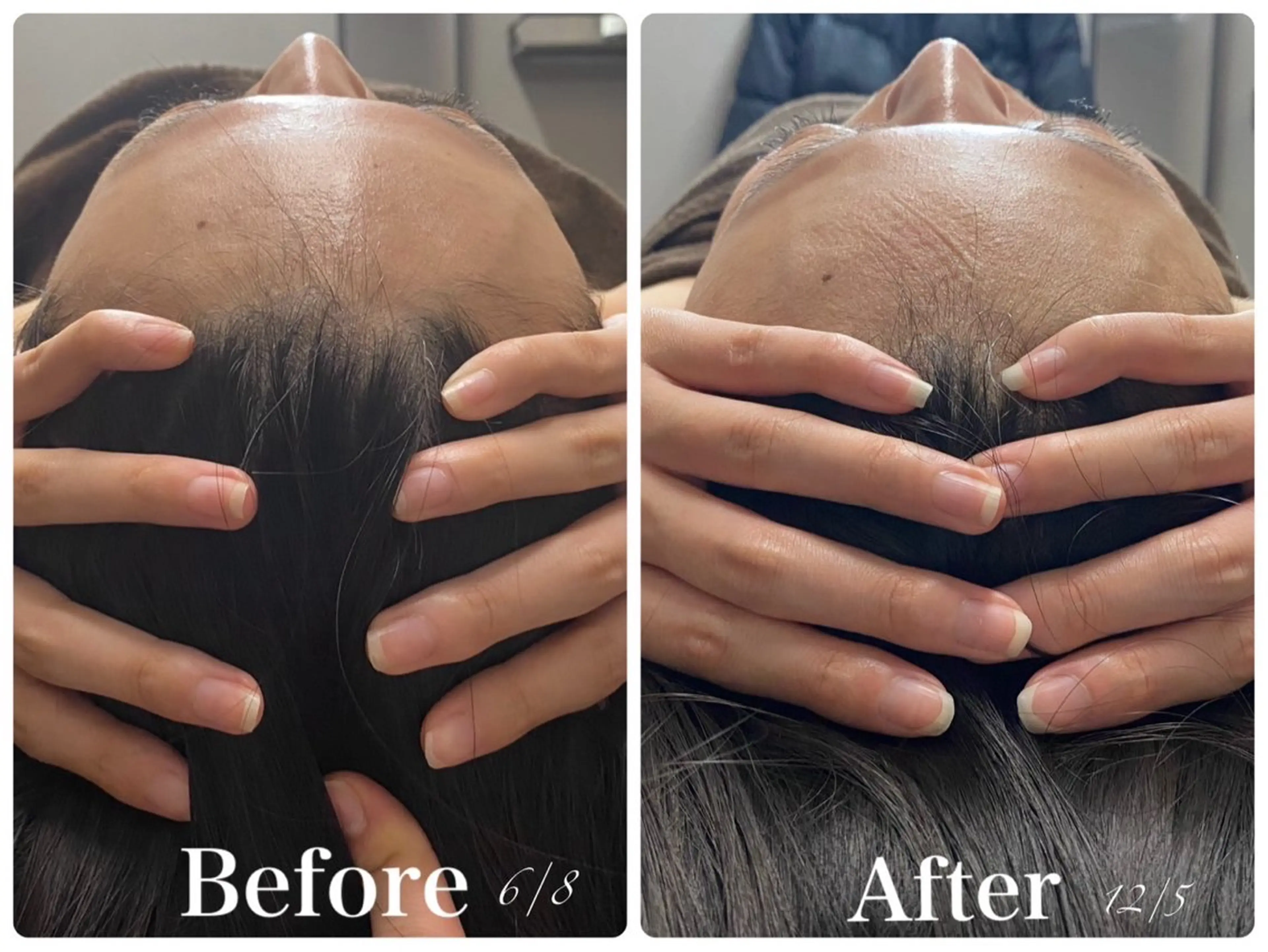 💆🏻‍♀️【究極の小顔コース！！】頭蓋骨矯正付き100min（¥24,200→¥4,950）※20歳以上の方限定の写真