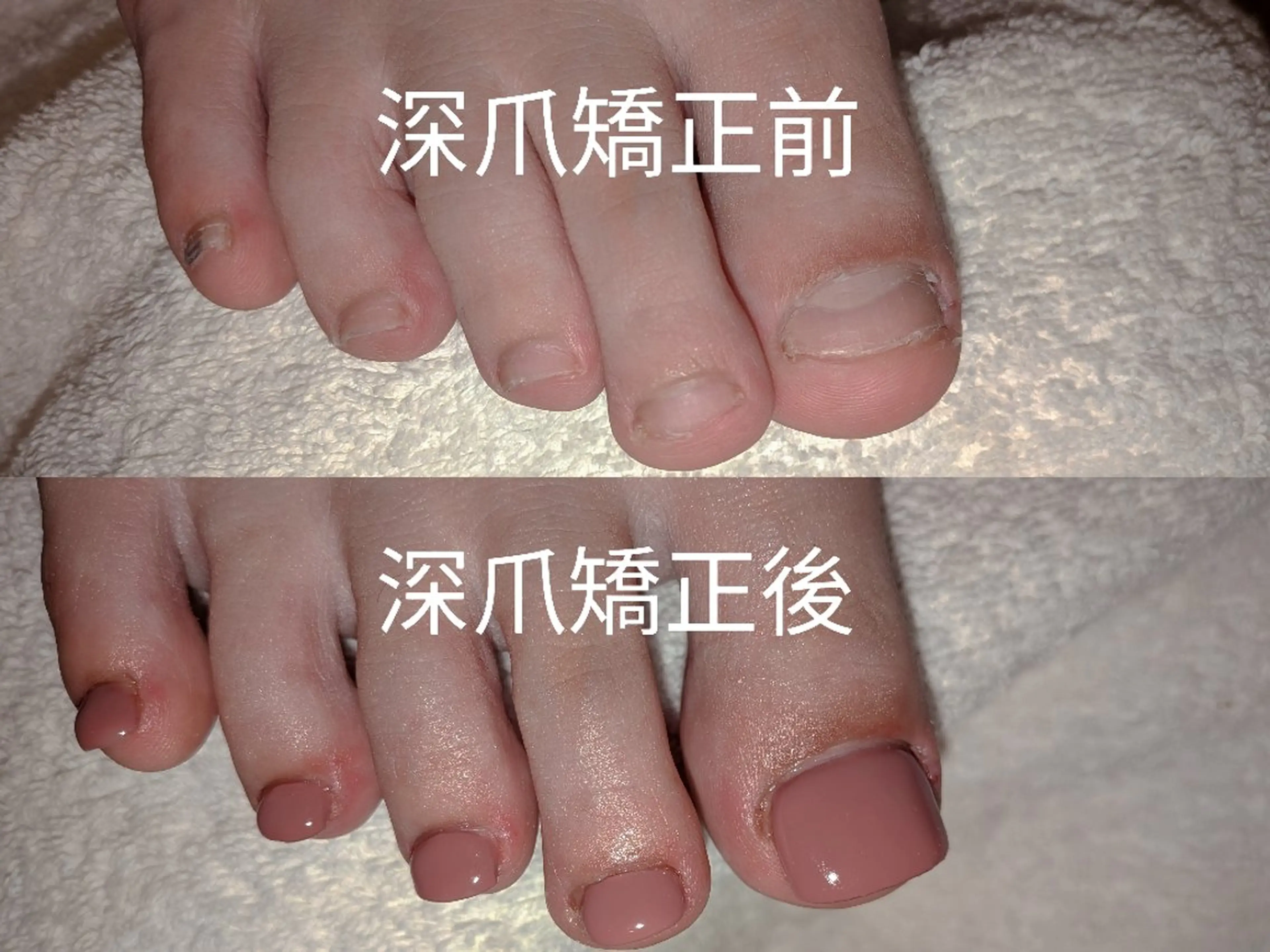 ネイル フットネイル ネイリストゆか💅 長さだし、深爪矯正のネイルデザイン