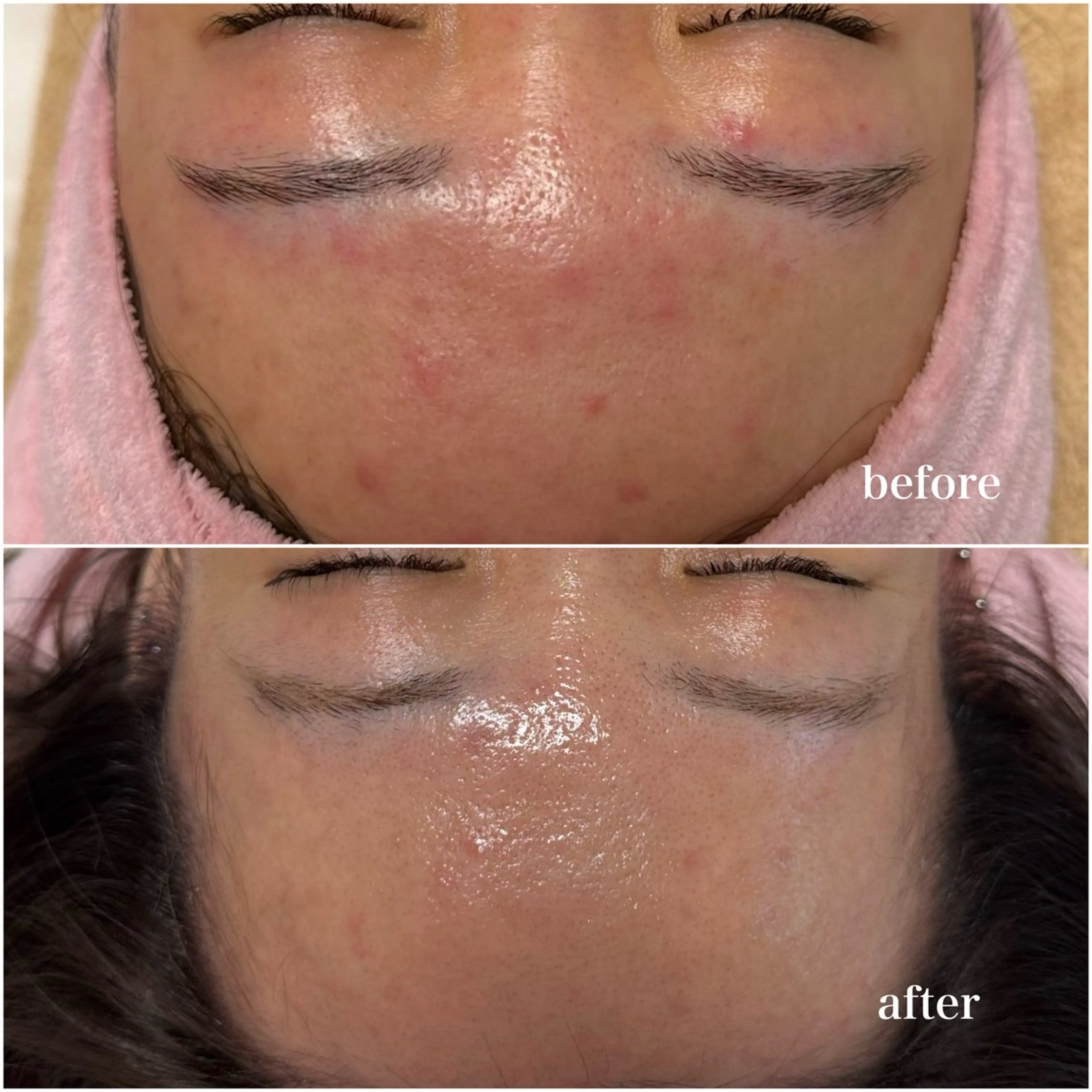 エステ 毛穴レス ハーブ＆ ワックス脱毛×光脱毛のエステ・リラクイメージ