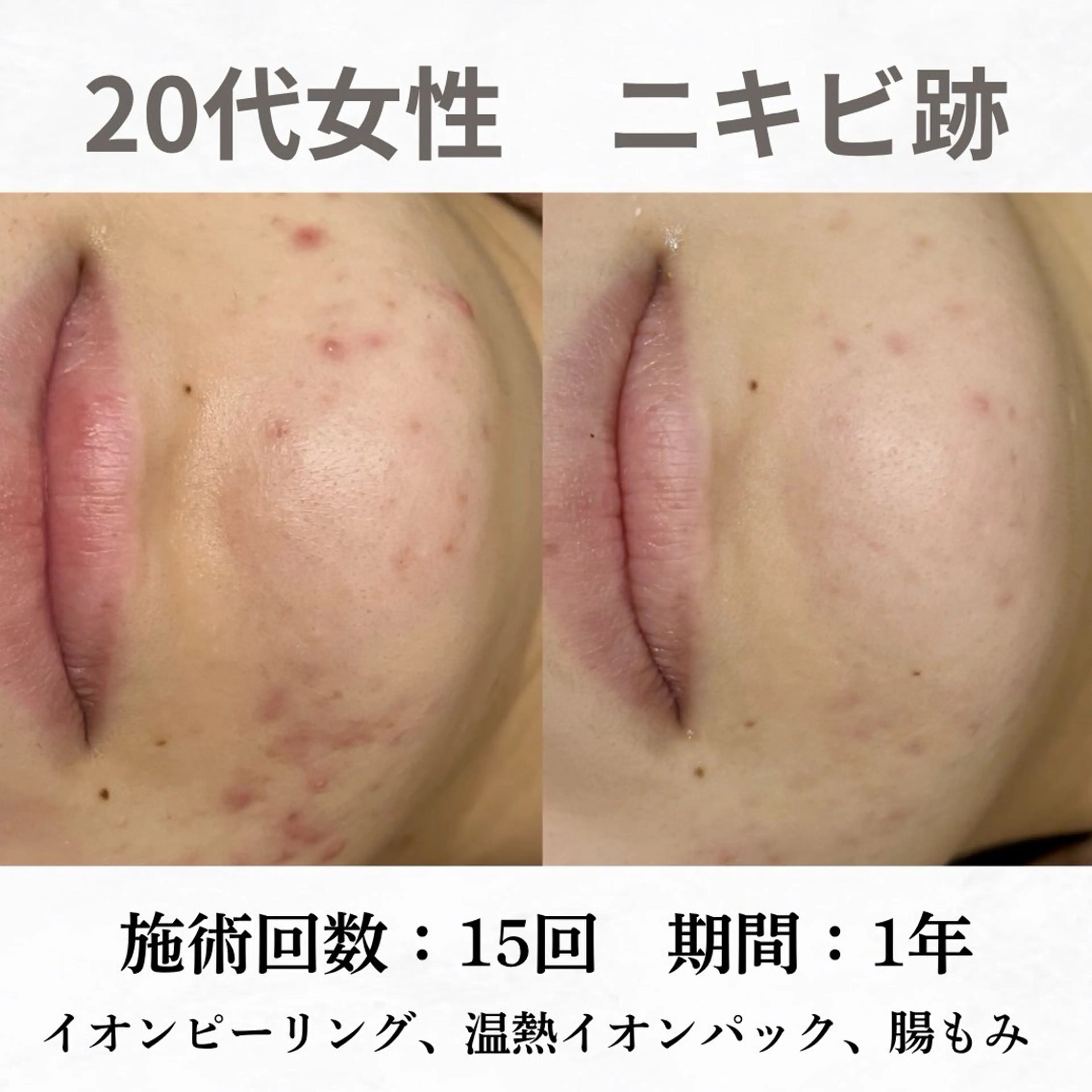 重度ニキビ専門🌷 ダウンタイムなしのエステ・リラクイメージ