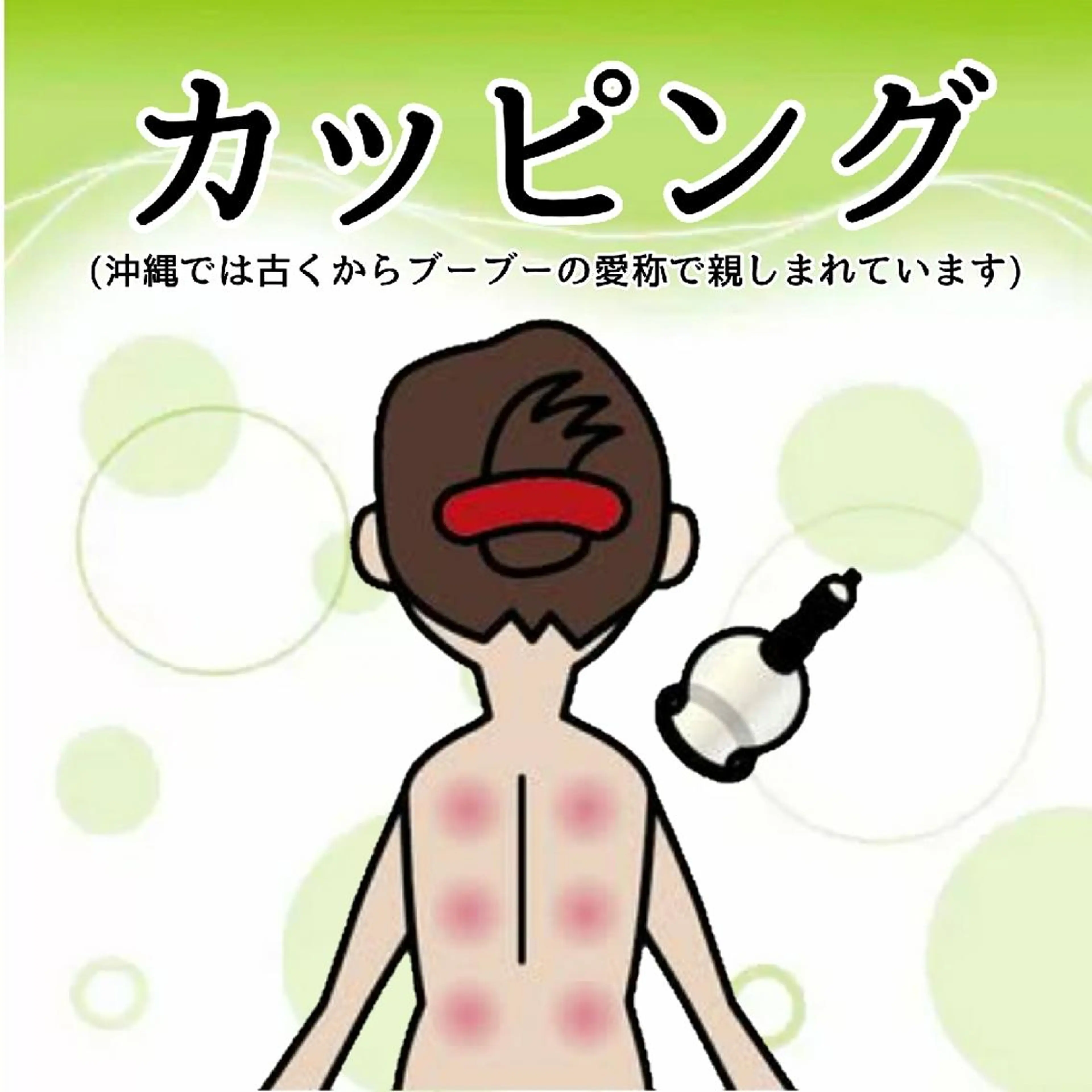 カッピング(瀉血なし)背中の写真