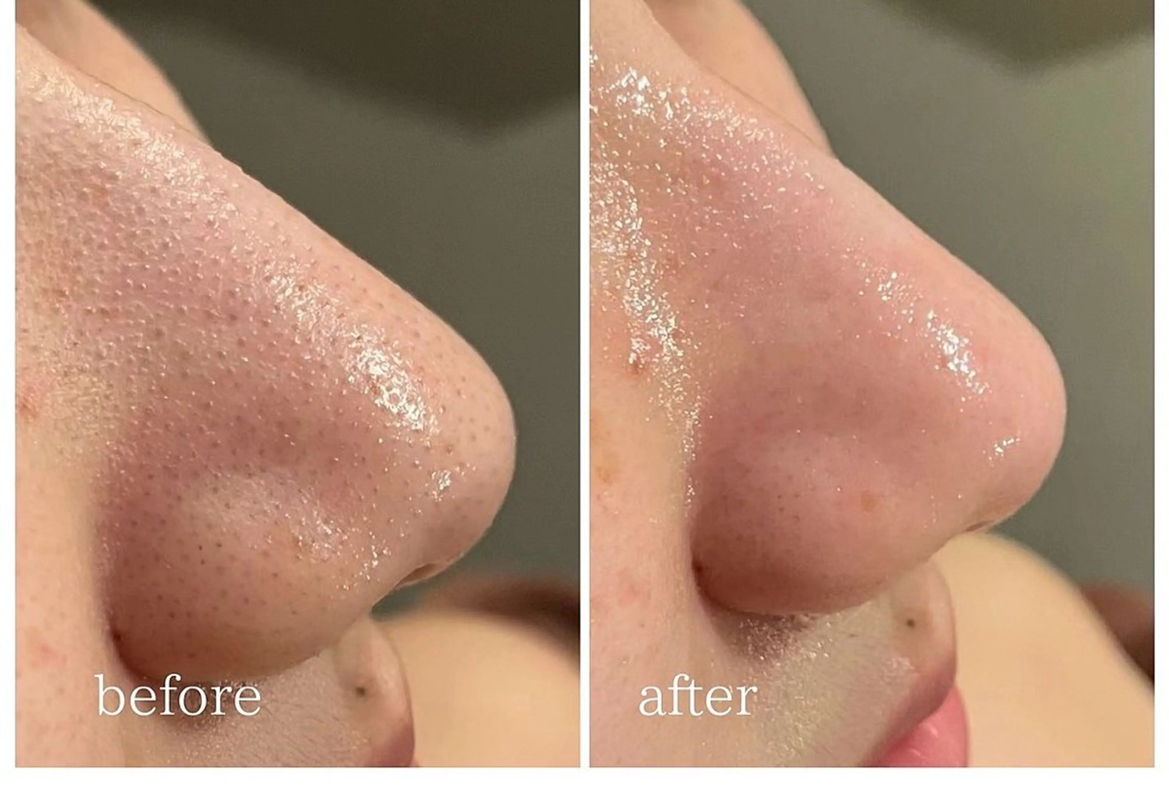 【毛穴黒ずみごっそり】毛穴洗浄フェイシャルの写真