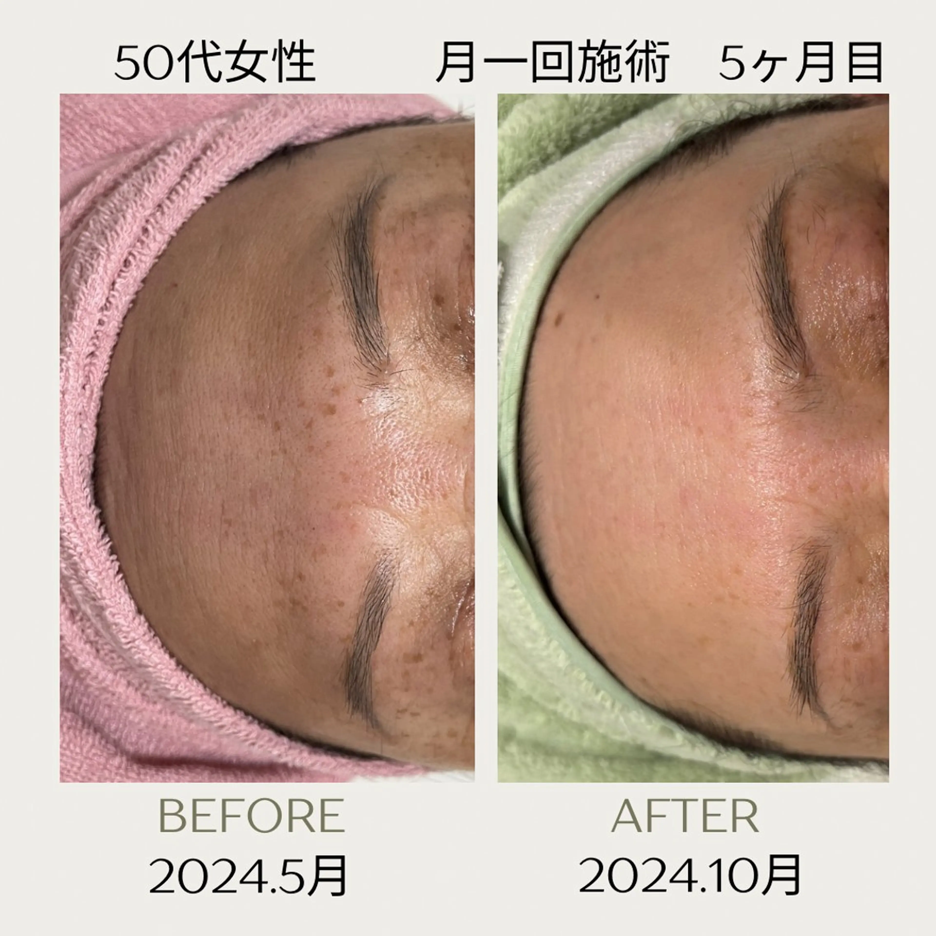 エステ ピーリングケア 🤍moekoのエステ・リラクイメージ