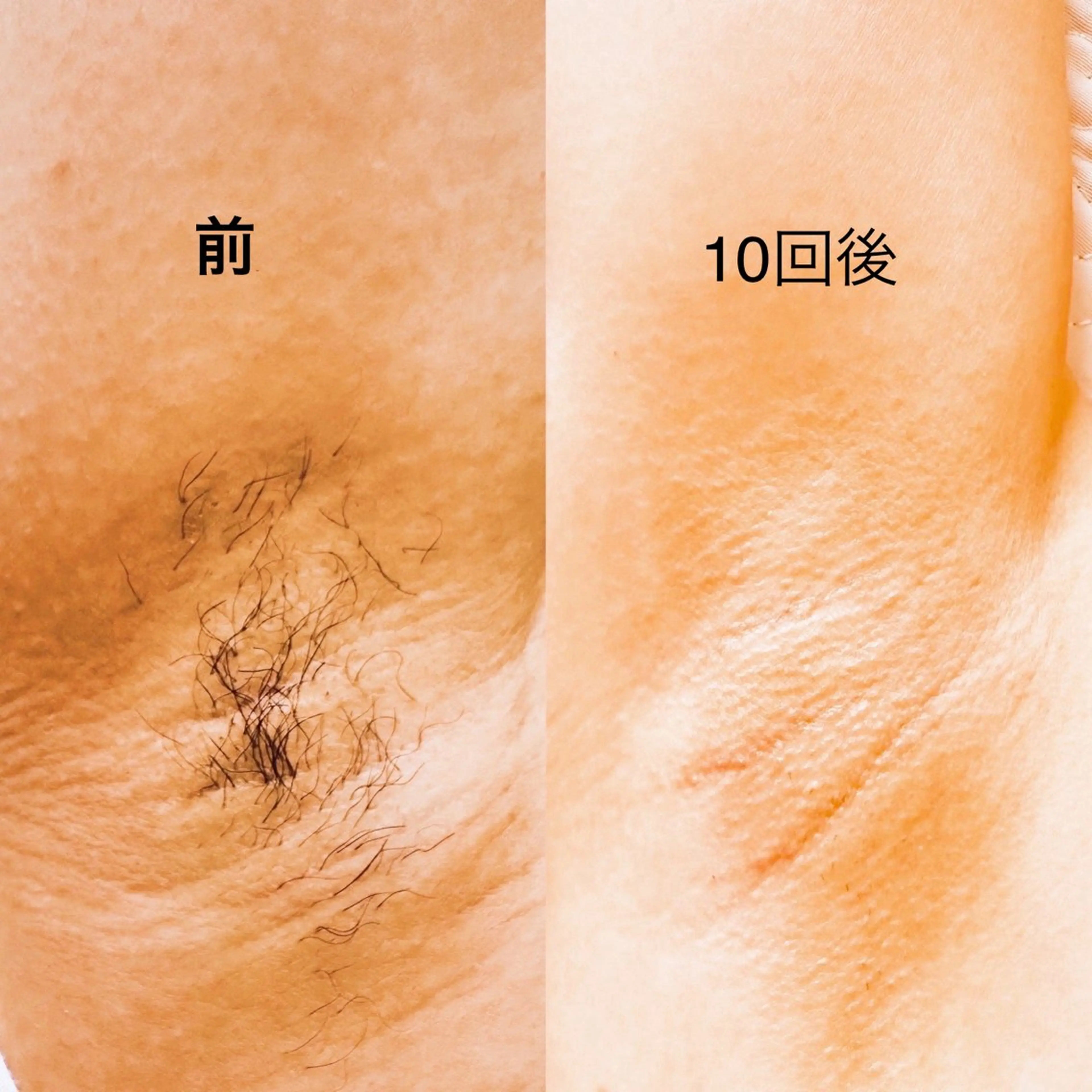 脱毛 Thu Huyen Beauty所属・トウ フェンのエステ・リラクイメージ