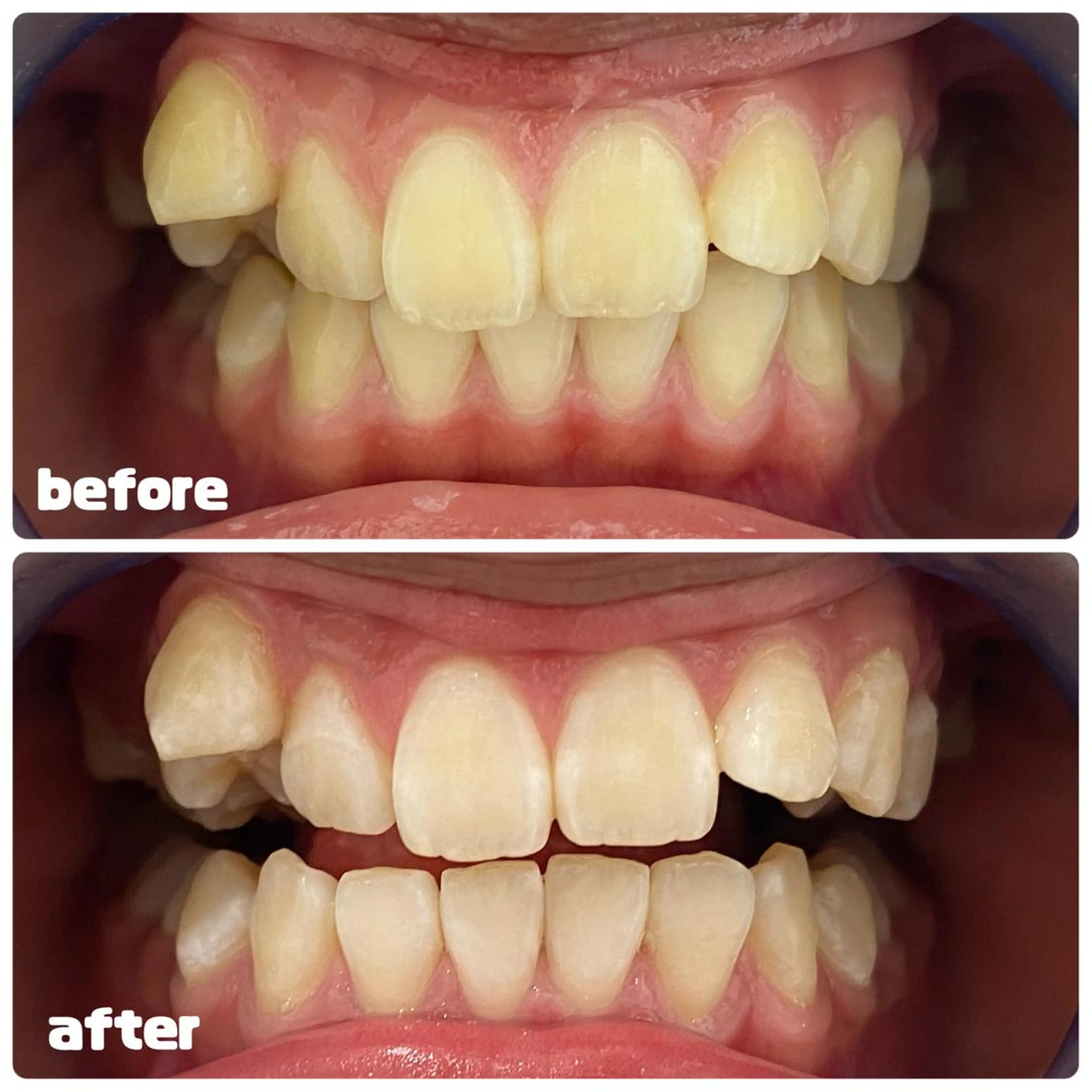 White Berry SELF BEAUTY SALON所属・セルフホワイトニング 🦷口元垢抜け✨のその他イメージ