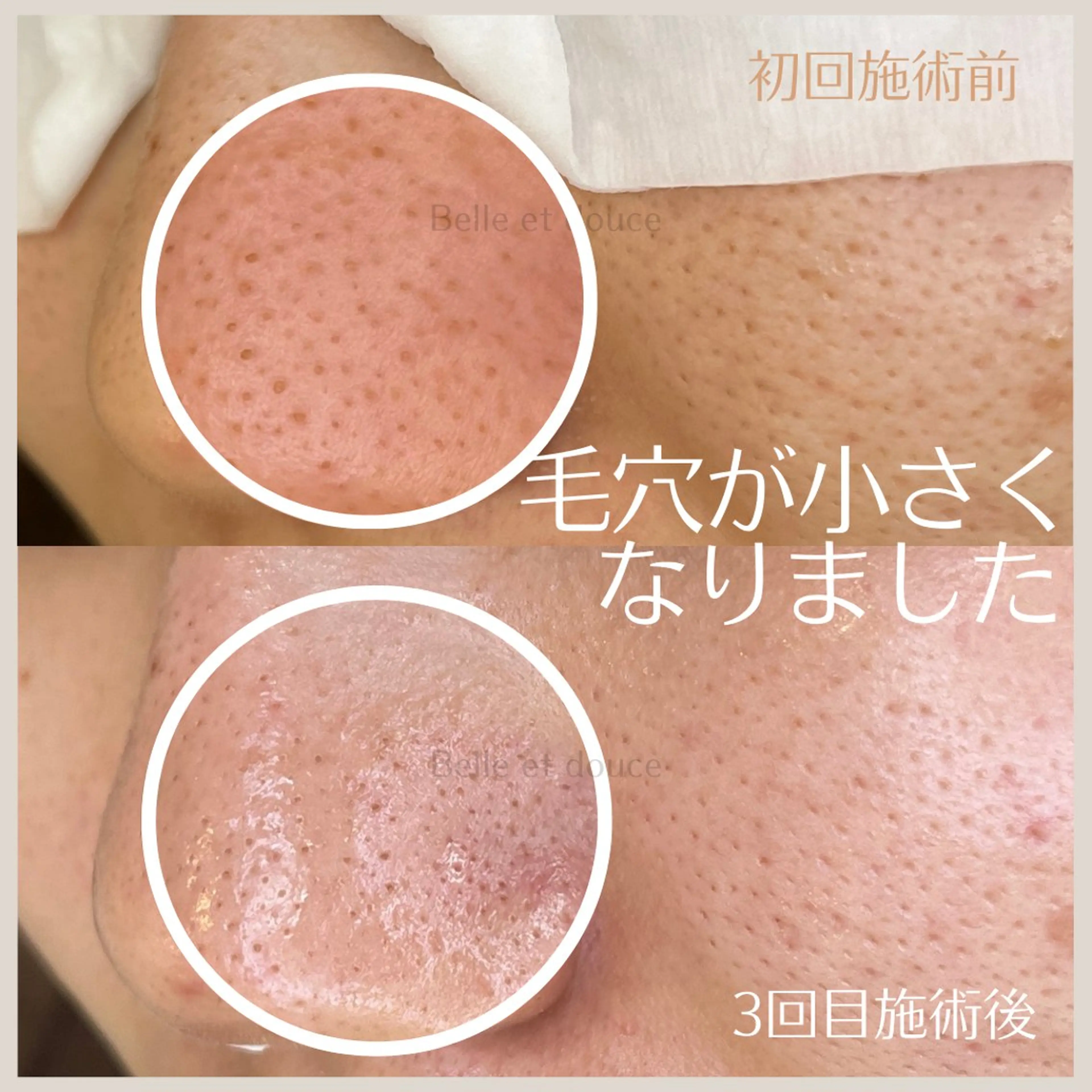 エステ Belle et douce所属・毛穴ケア専門サロン ベルエドゥースのエステ・リラクイメージ