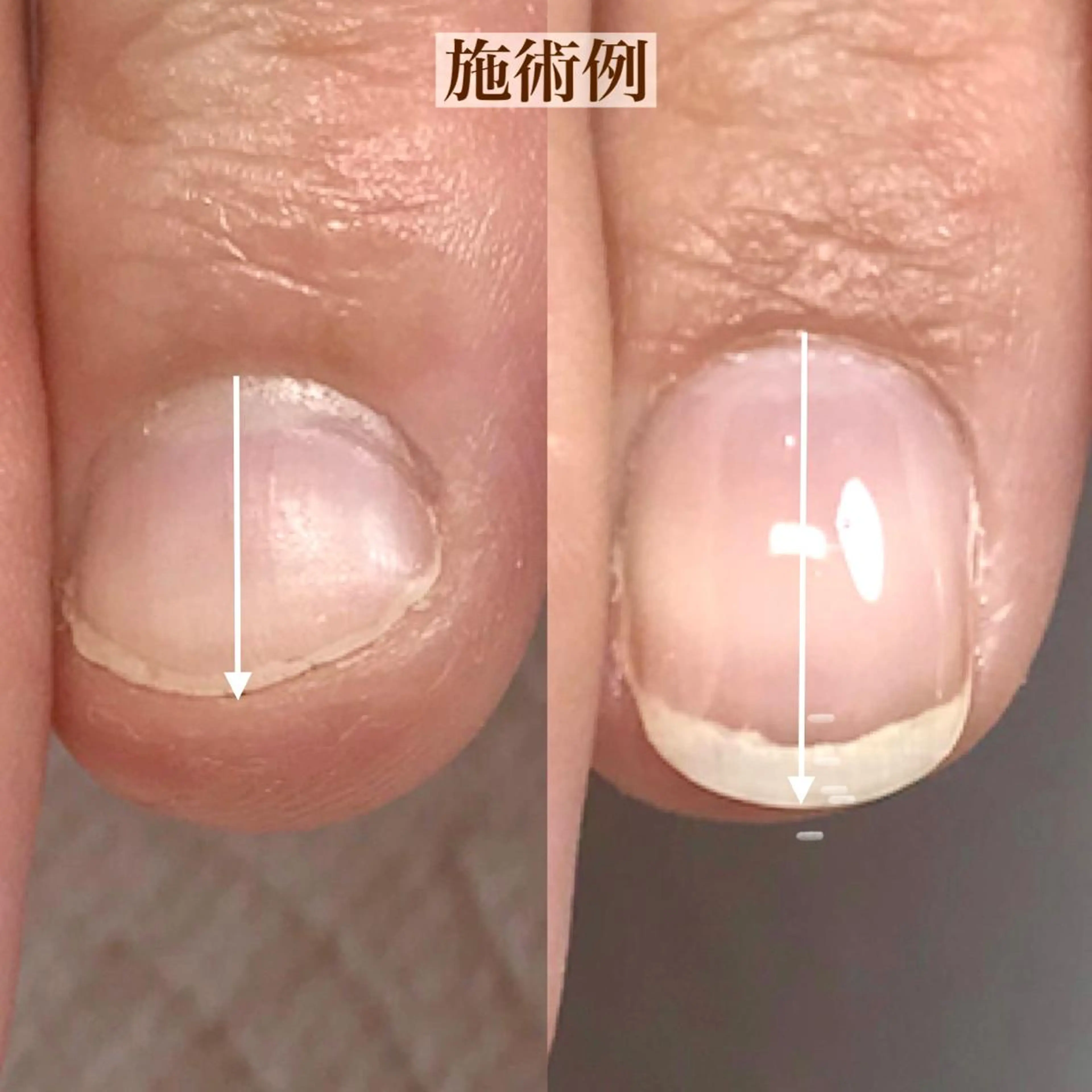 【噛み爪/トラブル爪/むしり癖】 深爪育成・美爪育成の写真