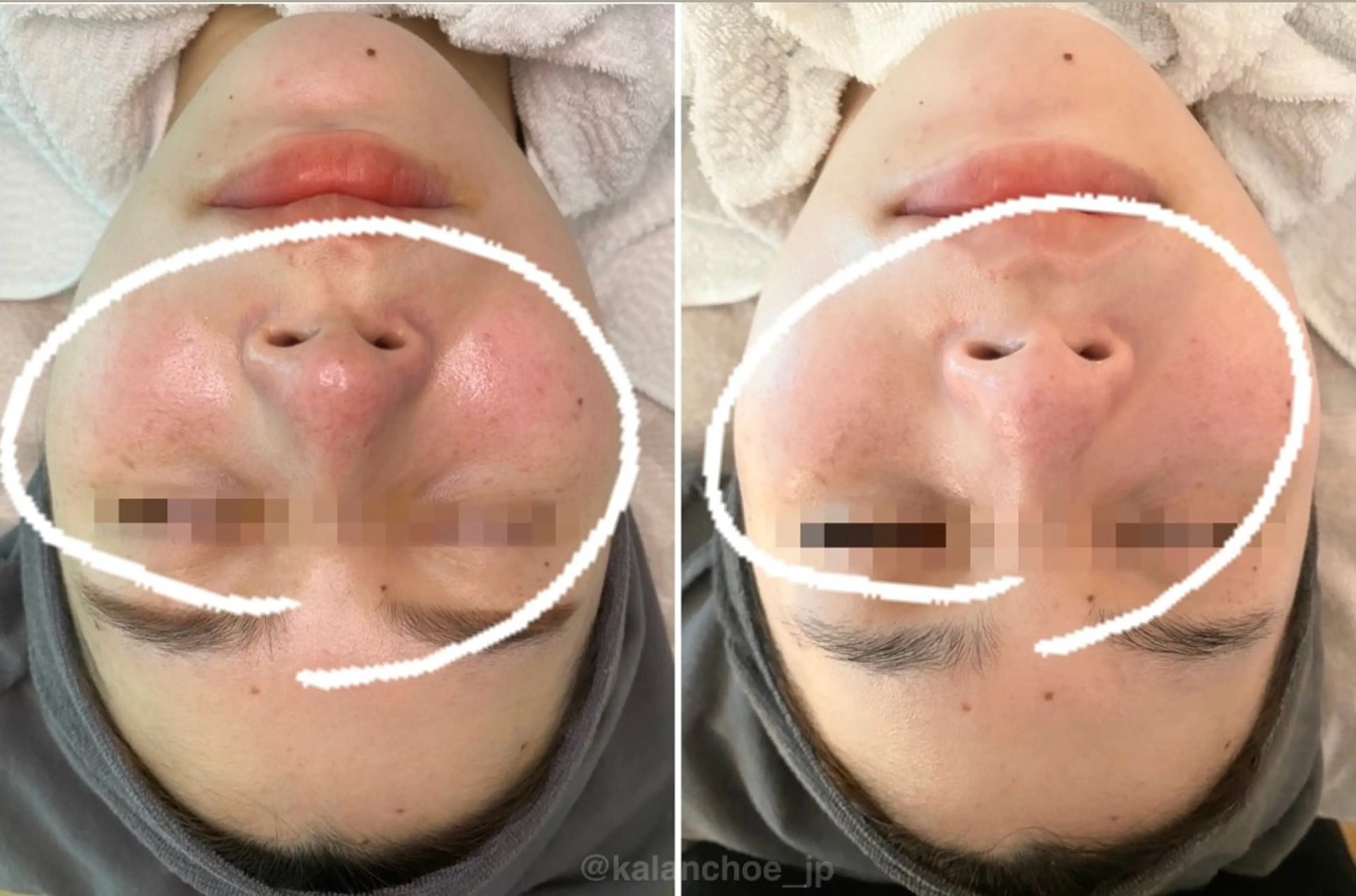 エステ 肌質改善 KALANCHOEのエステ・リラクイメージ