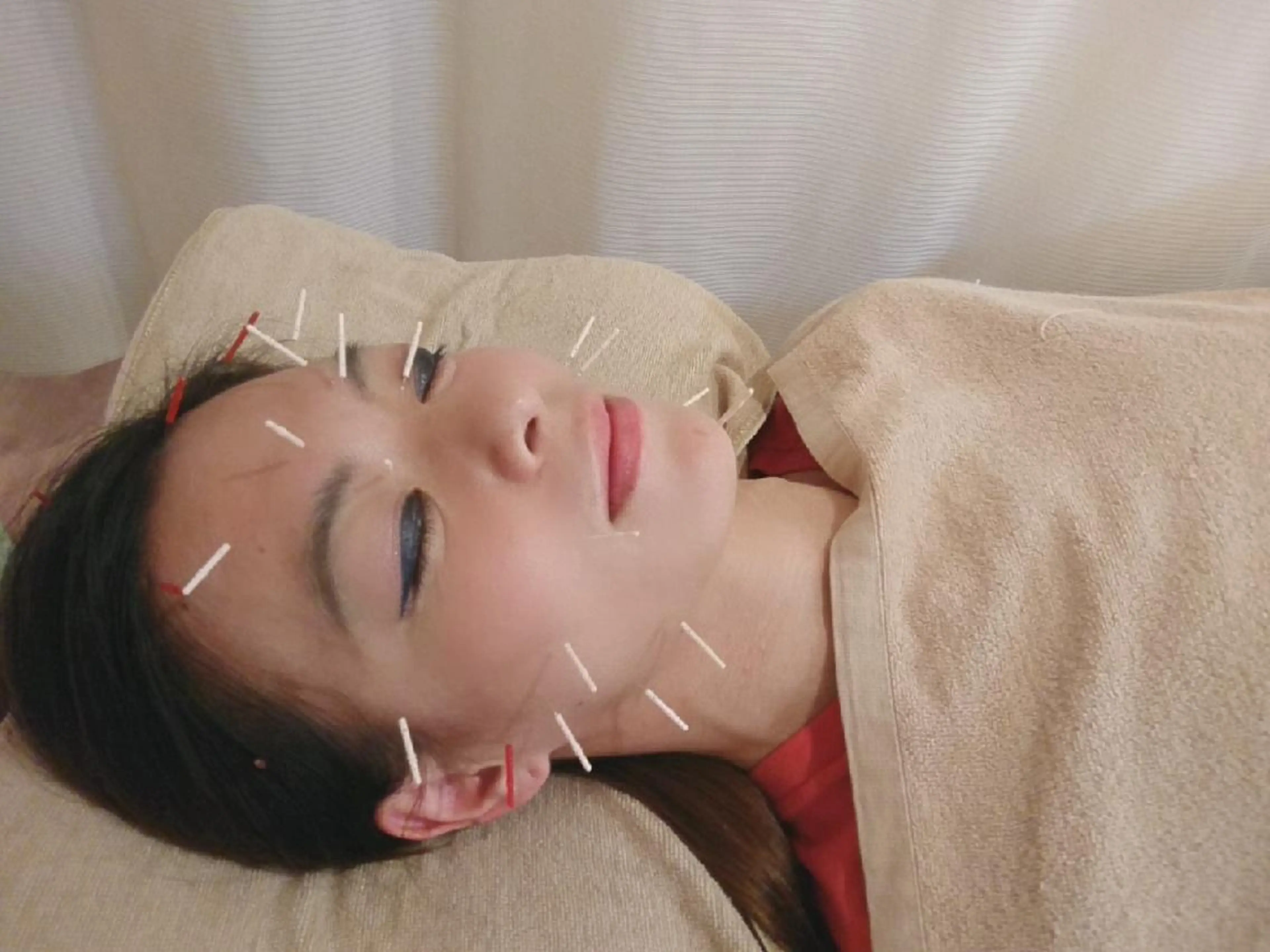 美顔鍼コースの写真