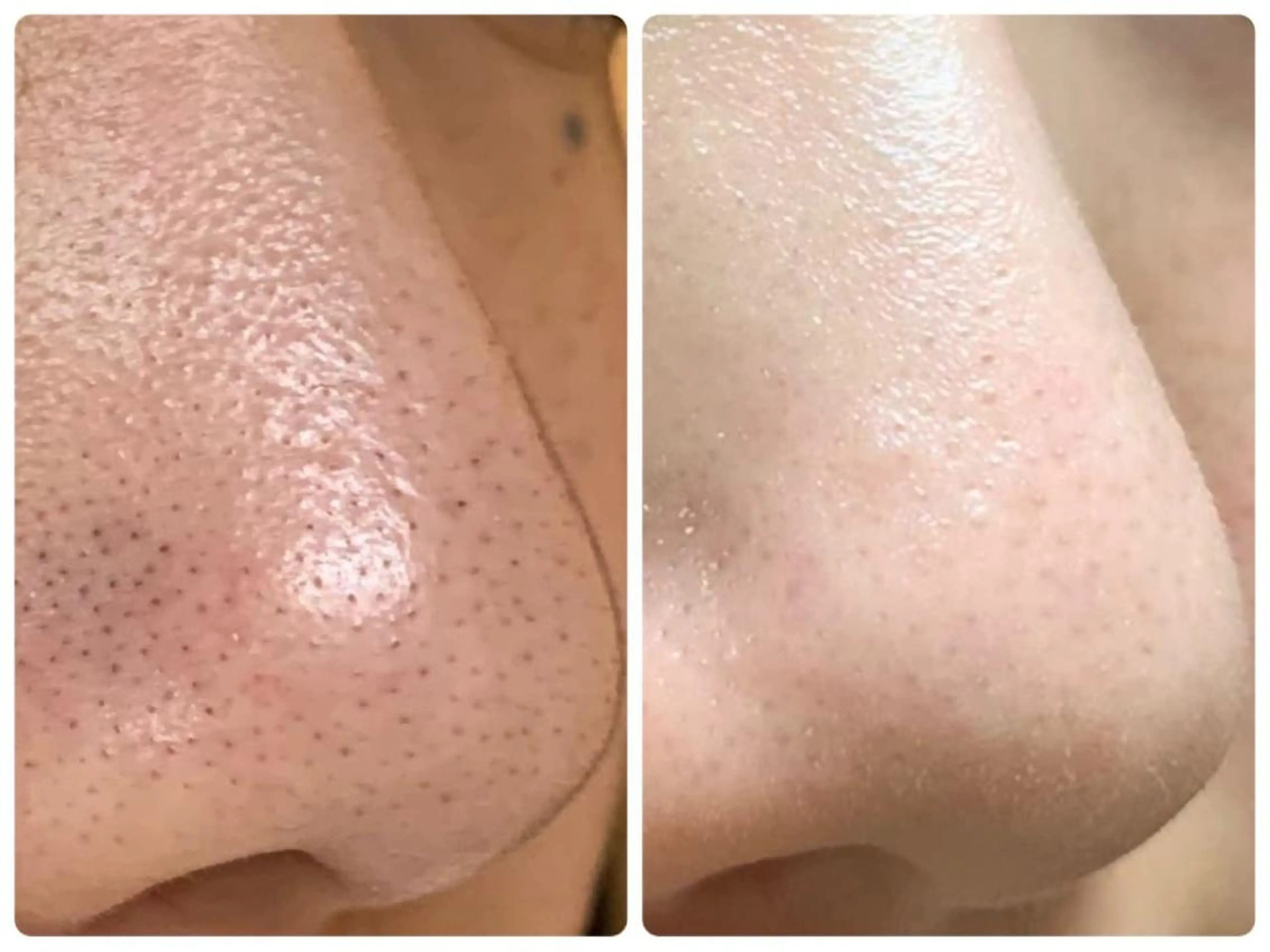 【今月限定★】毛穴改善フェイシャル★3回コース 19800円（1回6600円）の写真