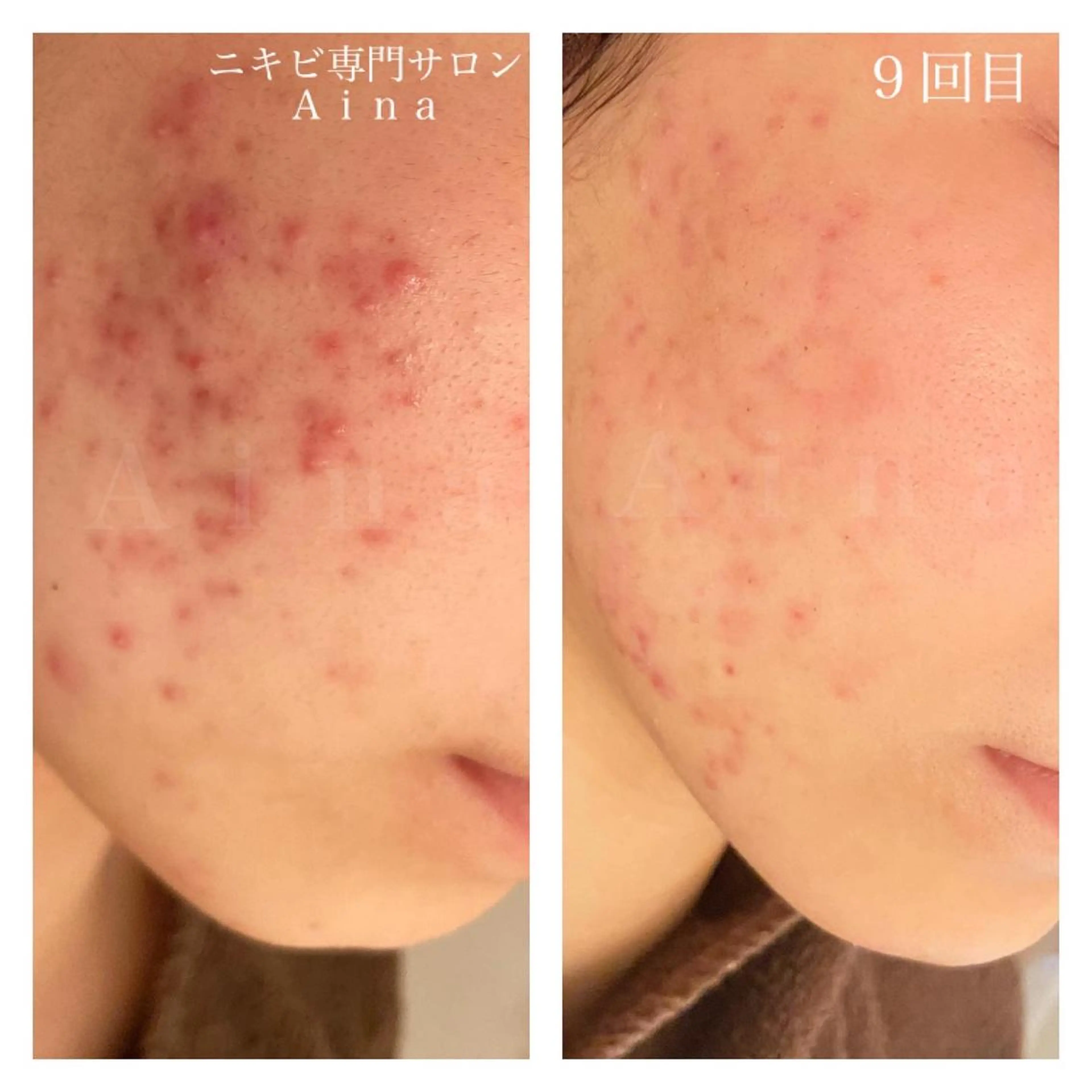 ショート カラー パーマ ヘアアレンジ メンズ キッズ ネイル マツエク・マツパ ブルーカラー ブルー 赤色 エステ リラク ニキビ跡専門サロン Ａｉｎａのエステ・リラクイメージ