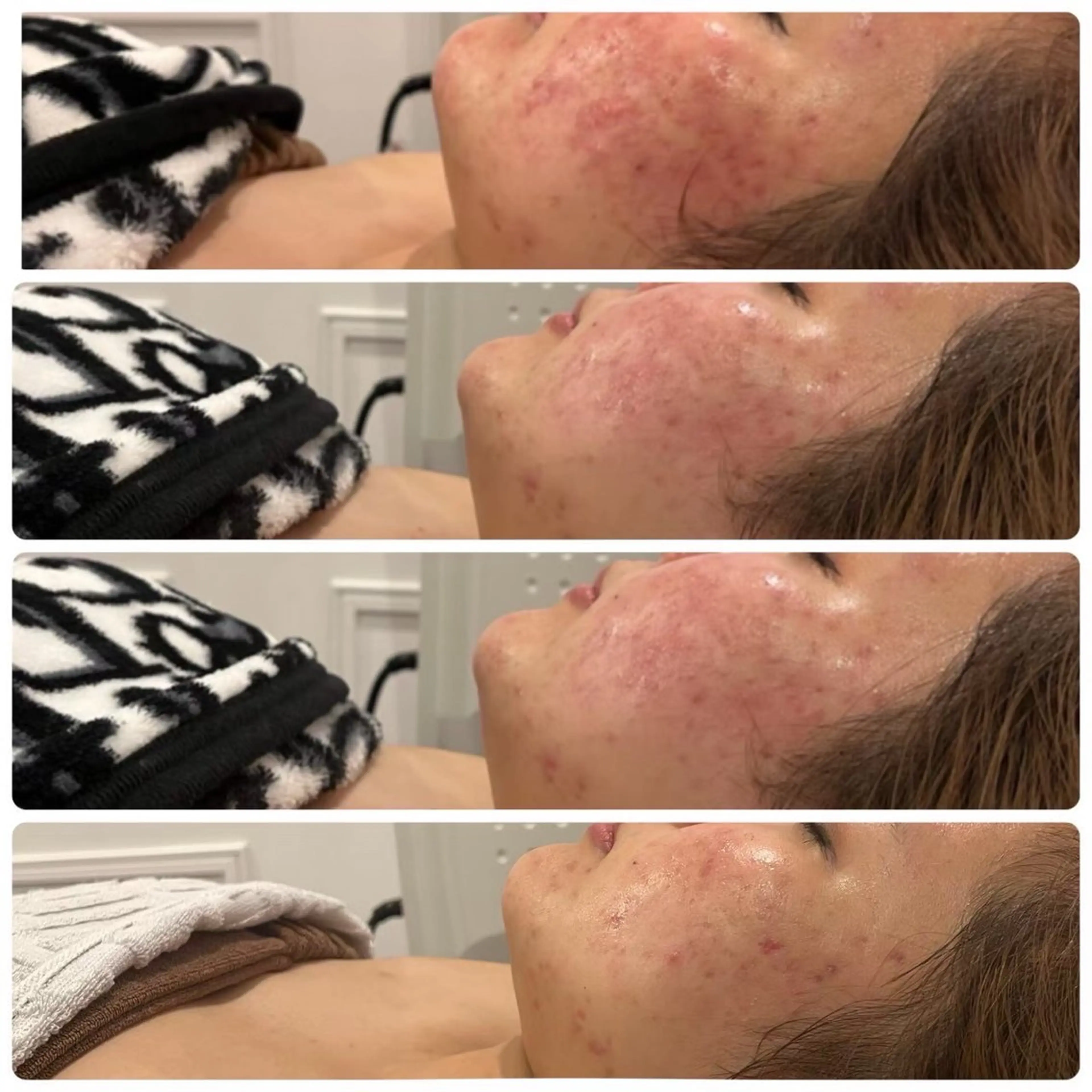 【敏感肌でも大丈夫な肌質改善】ニキビ･ニキビ跡集中‼️ダウンタイムなし！天然ハーブピーリング🌿20.30代の肌作り🩵の写真