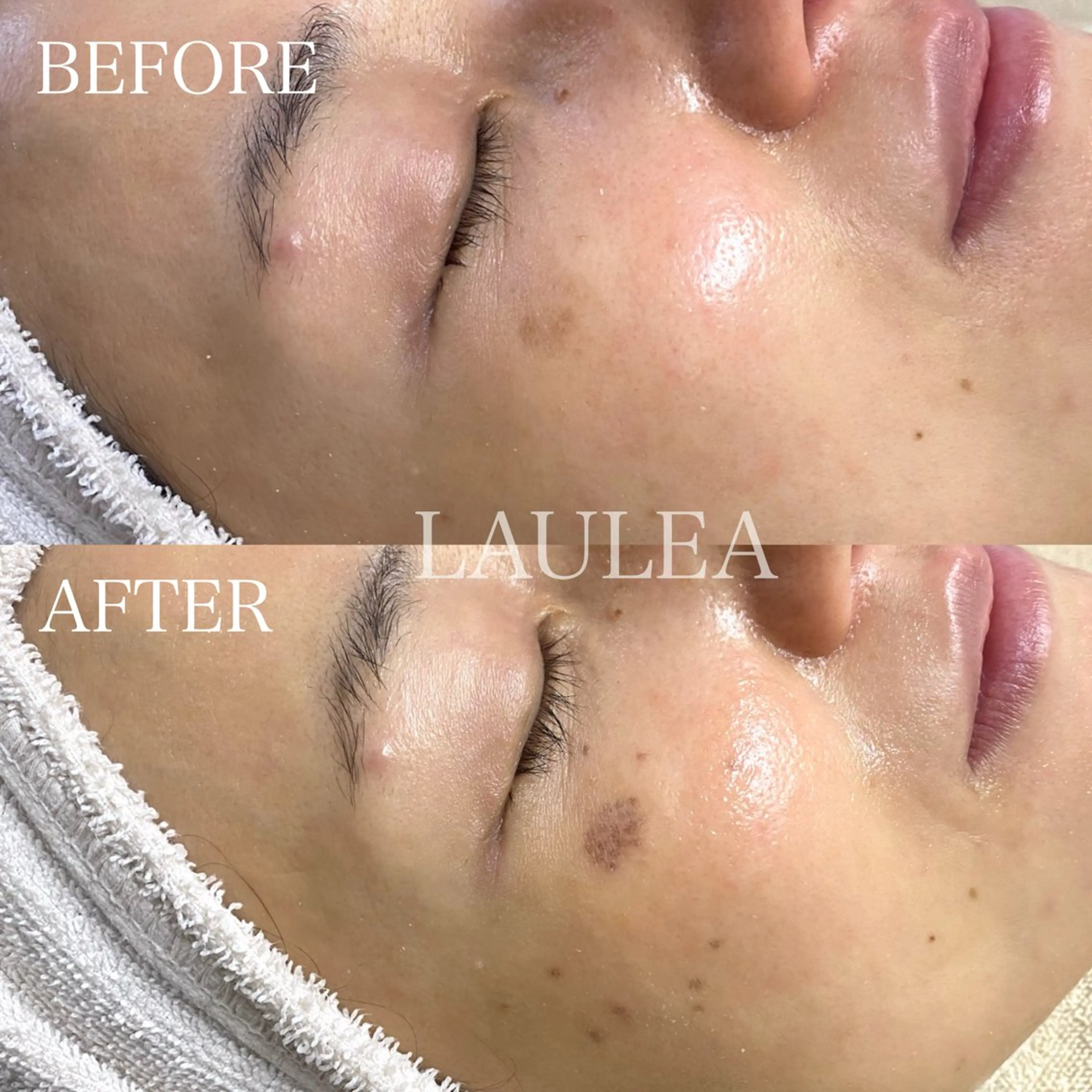 シミケア/ハーブピーリング/脱毛/小顔フェイシャル/ハーブ温浴　LAULEA所属・素肌をキレイに ラウレア🌼Hayaのエステ・リラクイメージ