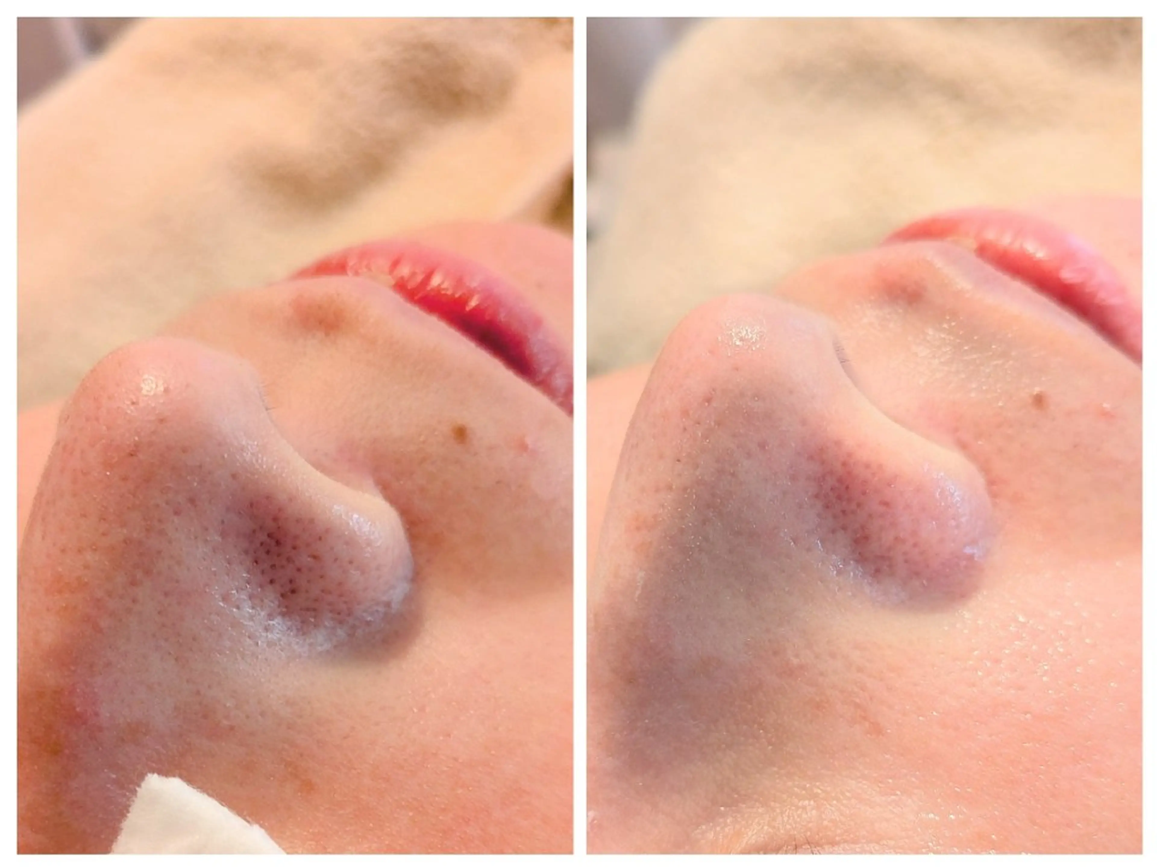 毛穴レスな艶肌へ 【毛穴】 毛穴エクストラクショ+美容液導入90分10,000円の写真