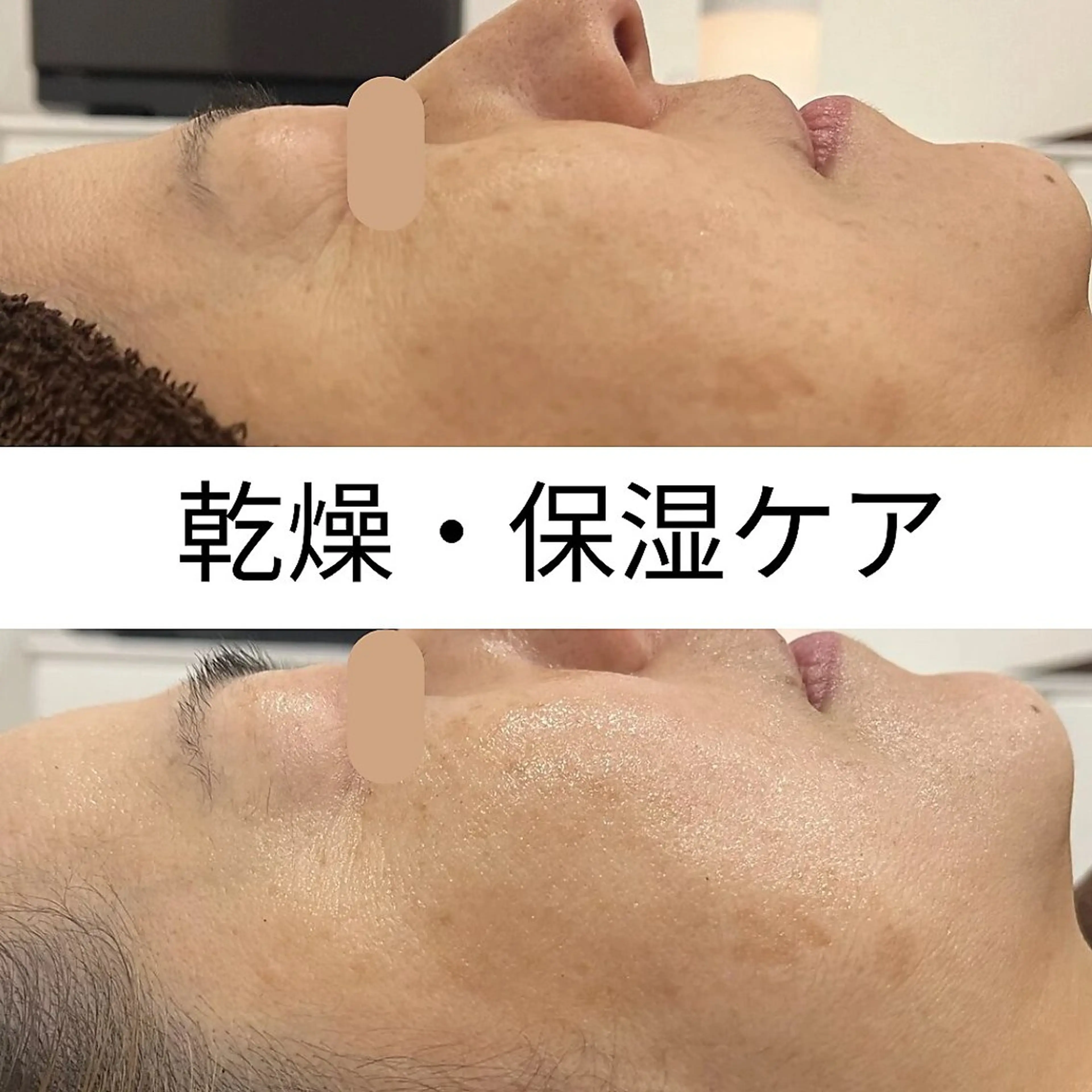 ぷるっとモチ肌【乾燥対策】剥けないハーブピーリング(パワーローズ付き)の写真