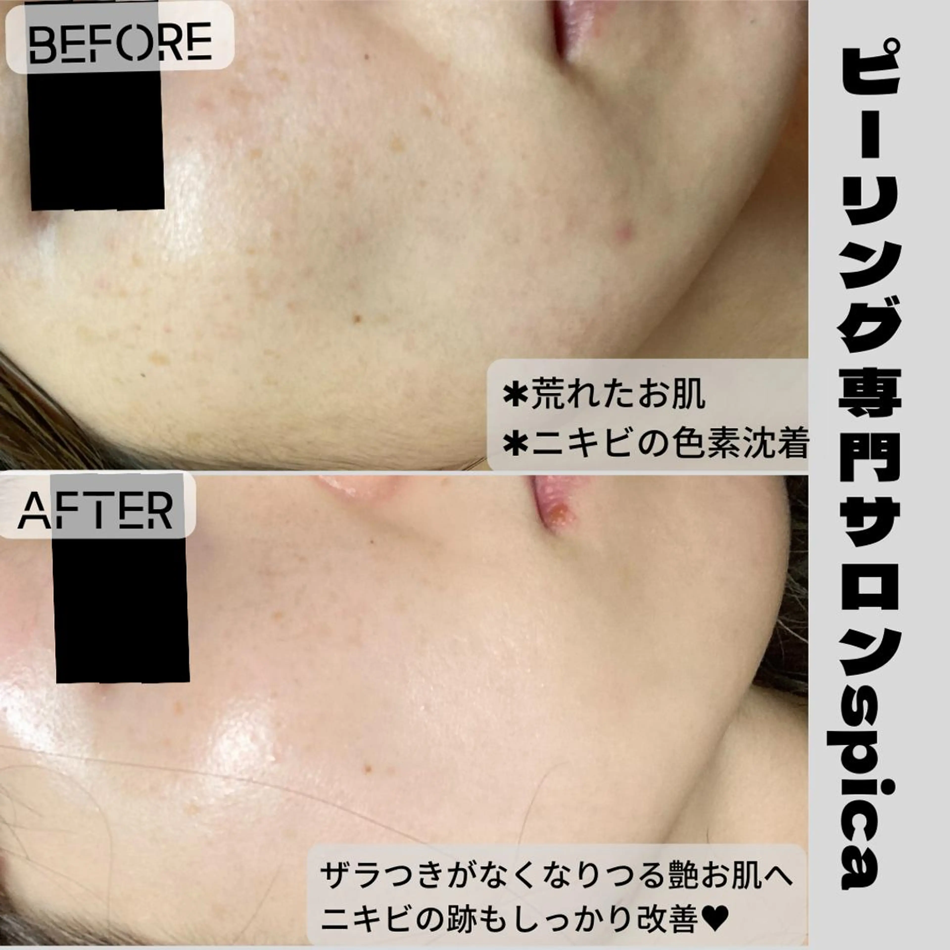 [次回予約]ハーブピーリングの写真