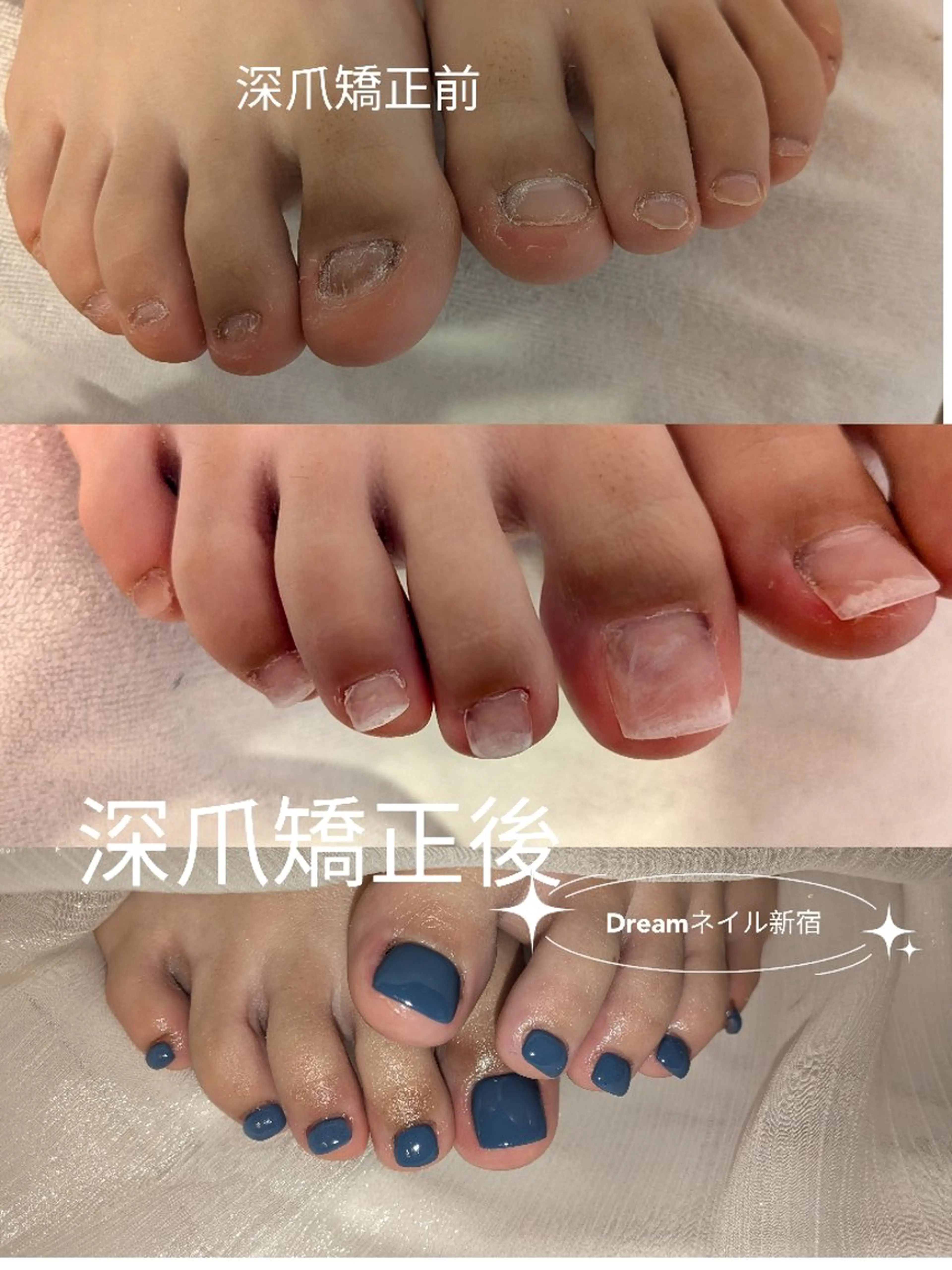 ネイル フットネイル フットネイル ネイリストゆか💅 長さだし、深爪矯正のネイルデザイン
