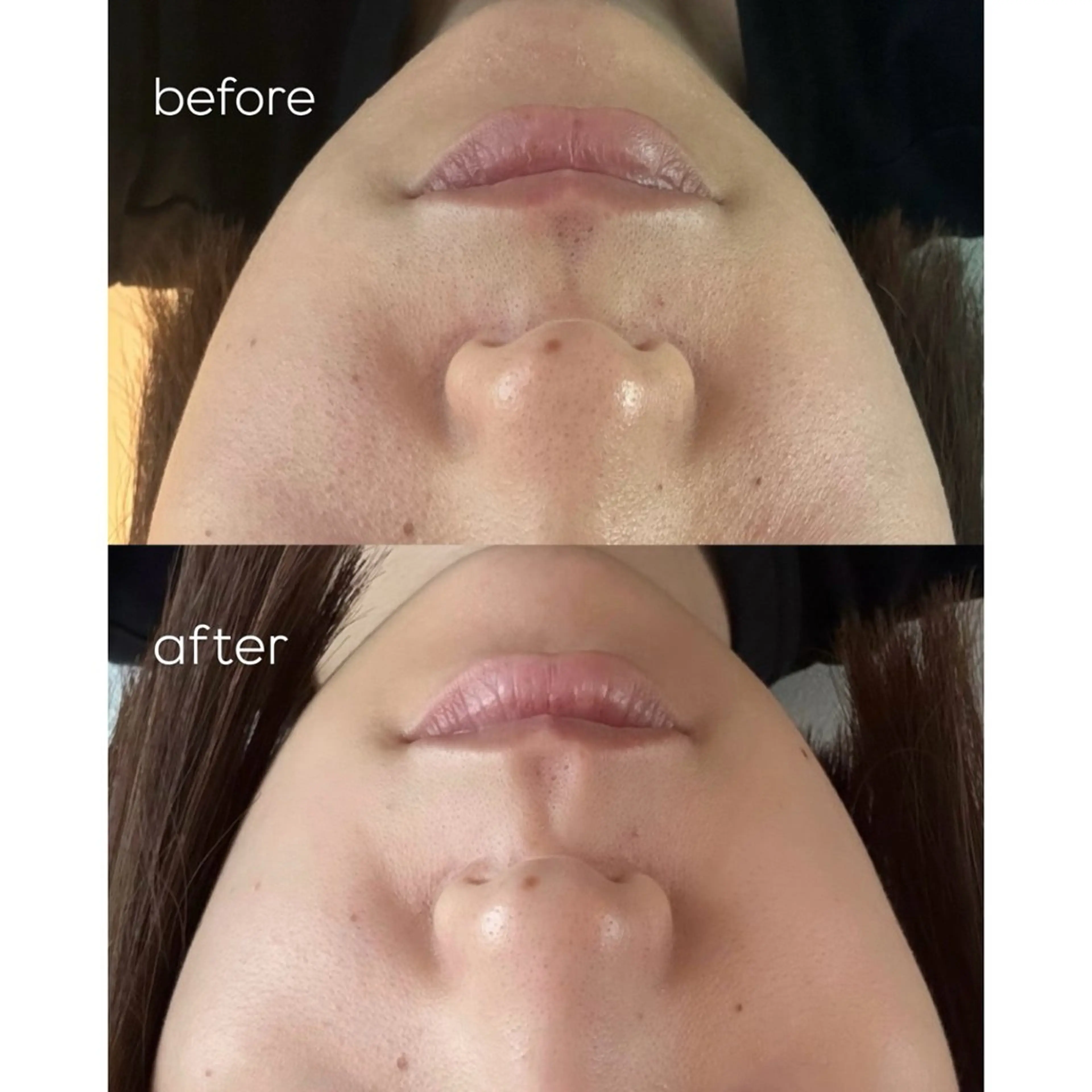 エステ リラク himee所属・艶肌ハーブピーリング /毛穴洗浄のエステ・リラクイメージ