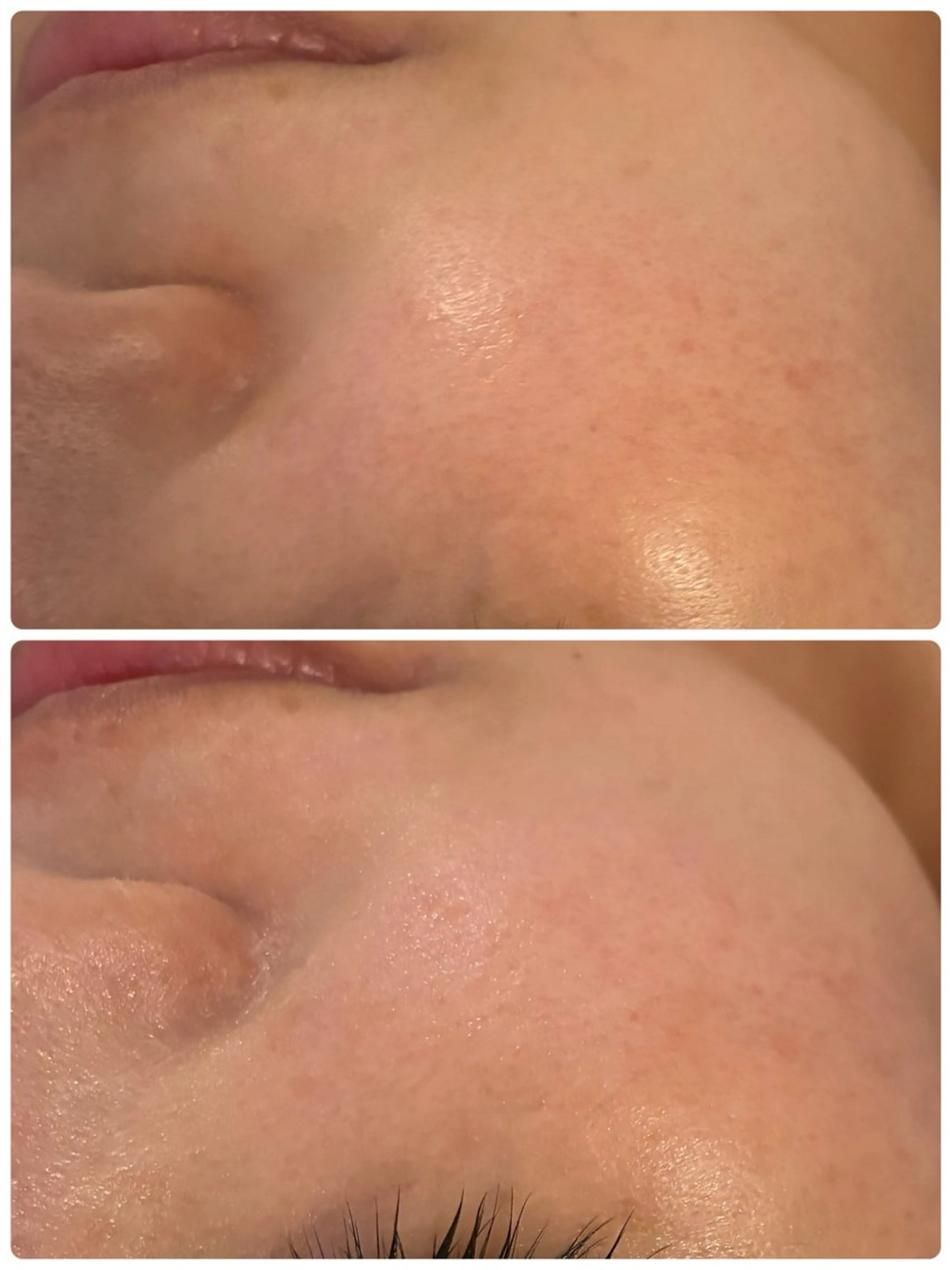 ポレーション、EMSフェイシャルの写真