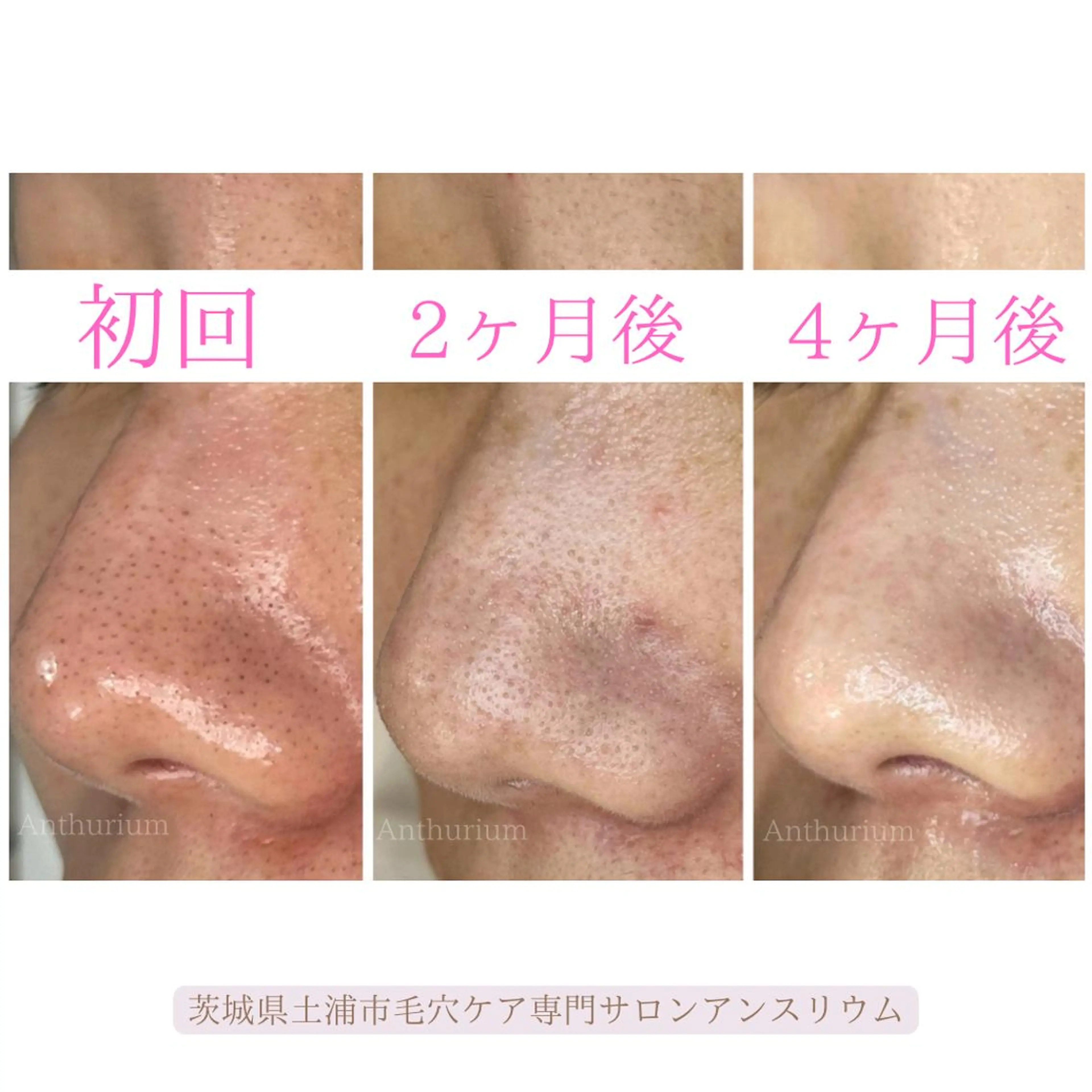 毛穴ケア専門サロンアンスリウム所属・茨城土浦 つくば毛穴 ケア専門サロンのエステ・リラクイメージ