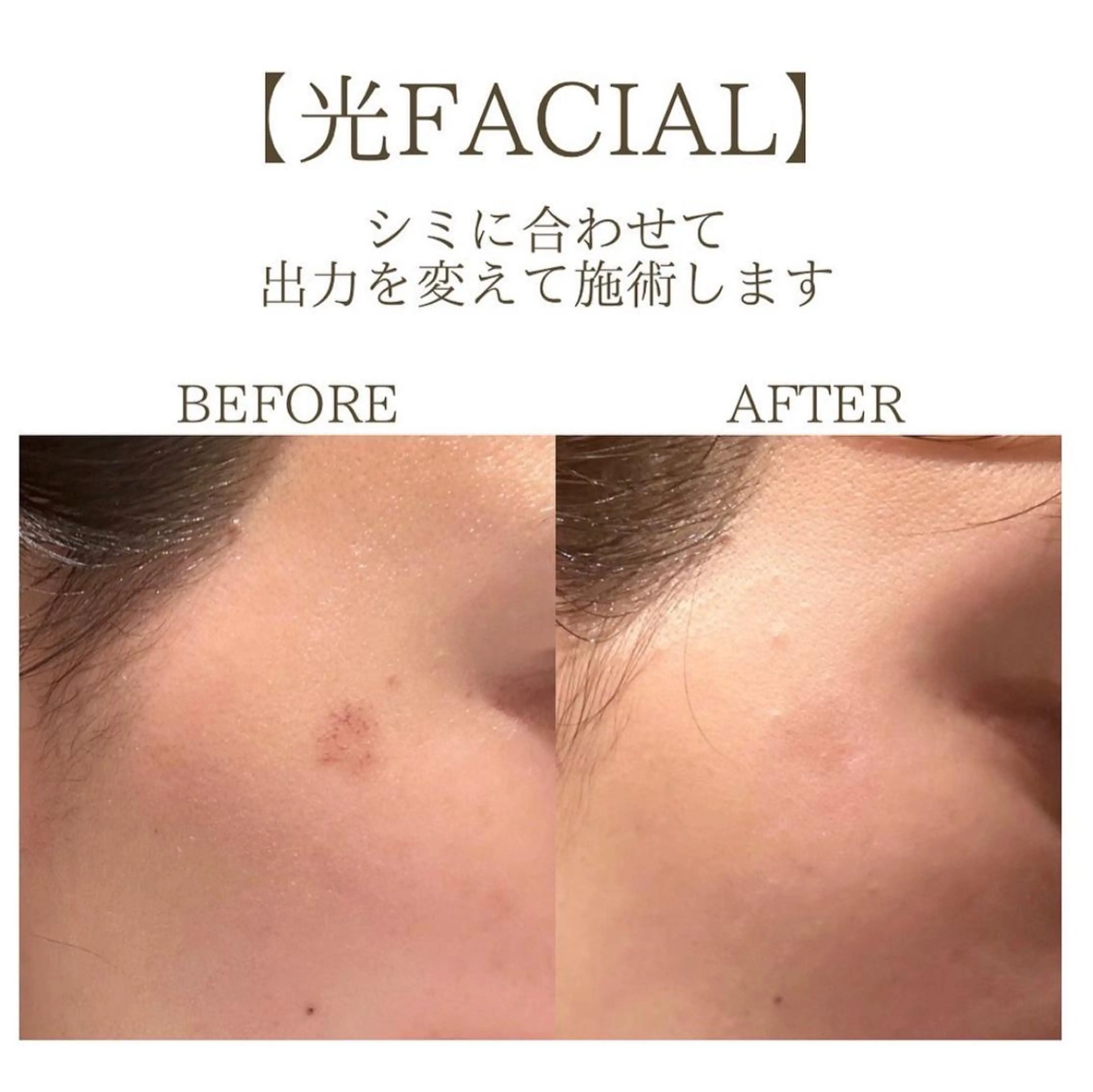 【メンズ歓迎】光フェイシャル タイトニング＋トーニング＋シミケア照射◎￥8,000の写真