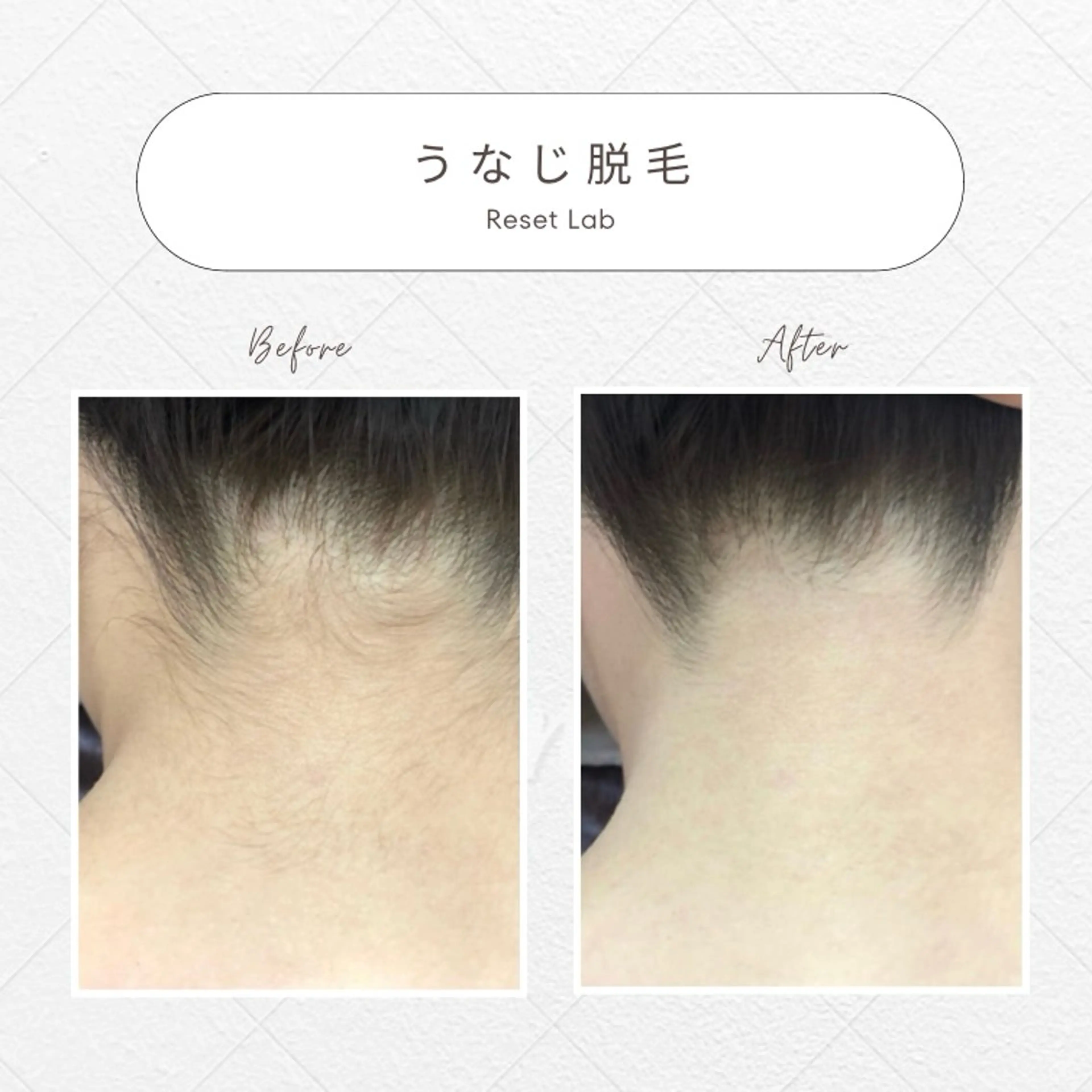 🌸うなじ＆背中脱毛《限定⛄️》スペシャルクーポン♪の写真