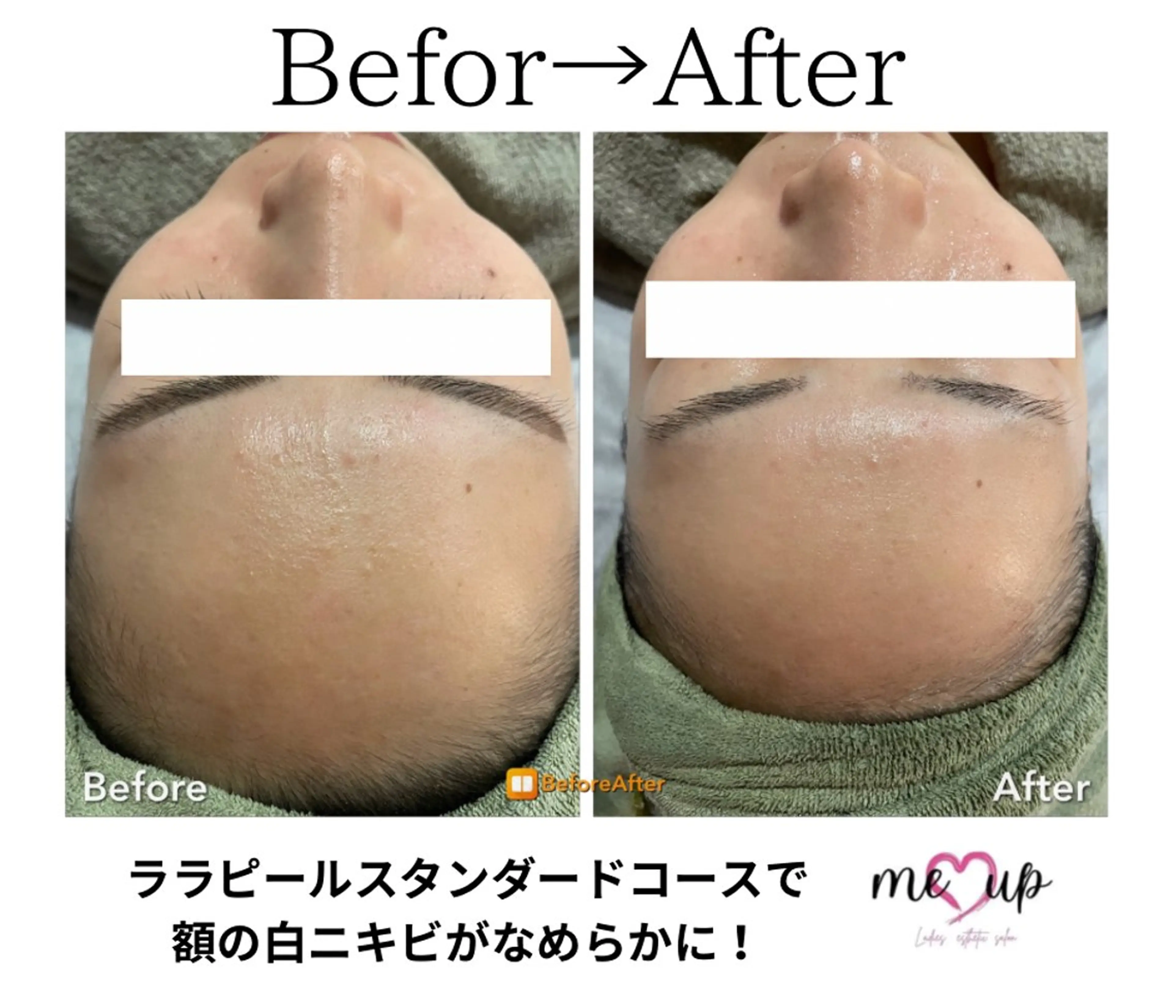 エステ Meupニキビ専門店 背中/ハーブ/肌管理のその他イメージ