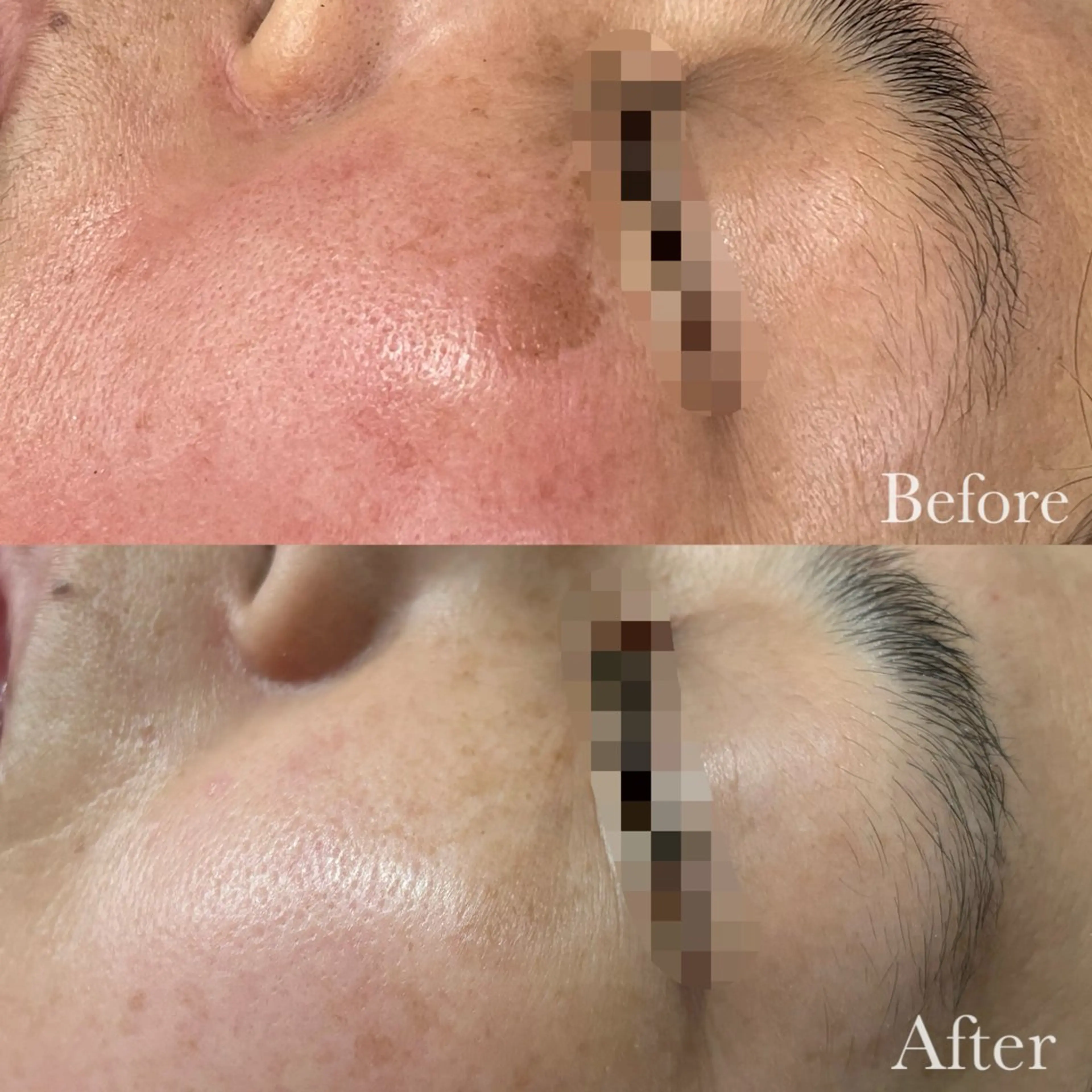 美容鍼脱毛salon リノン吹田駅前店のエステ・リラクイメージ