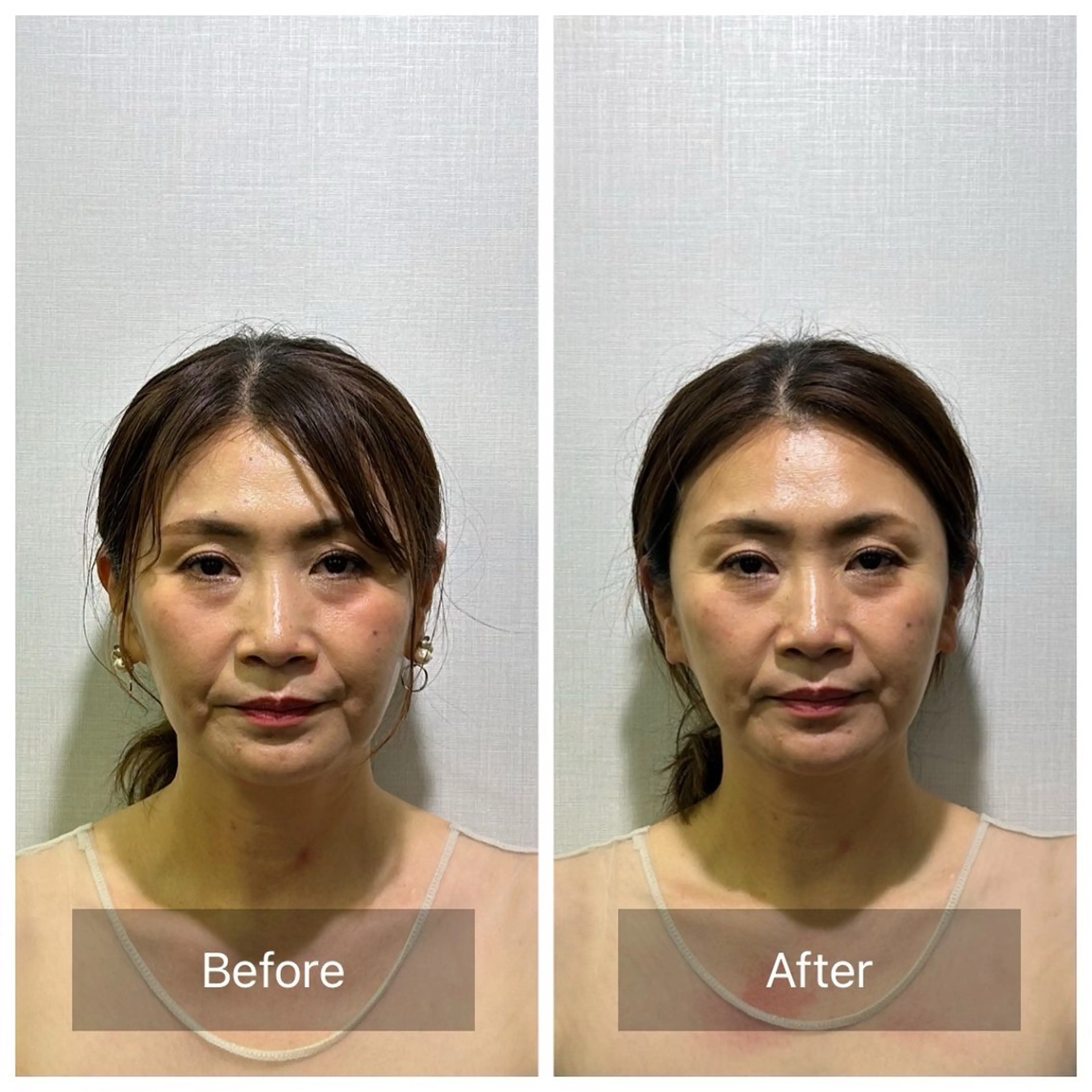 【食いしばり美容鍼】むくみ撃退&たるみ&歯ぎしり¥12,000→¥4,980の写真