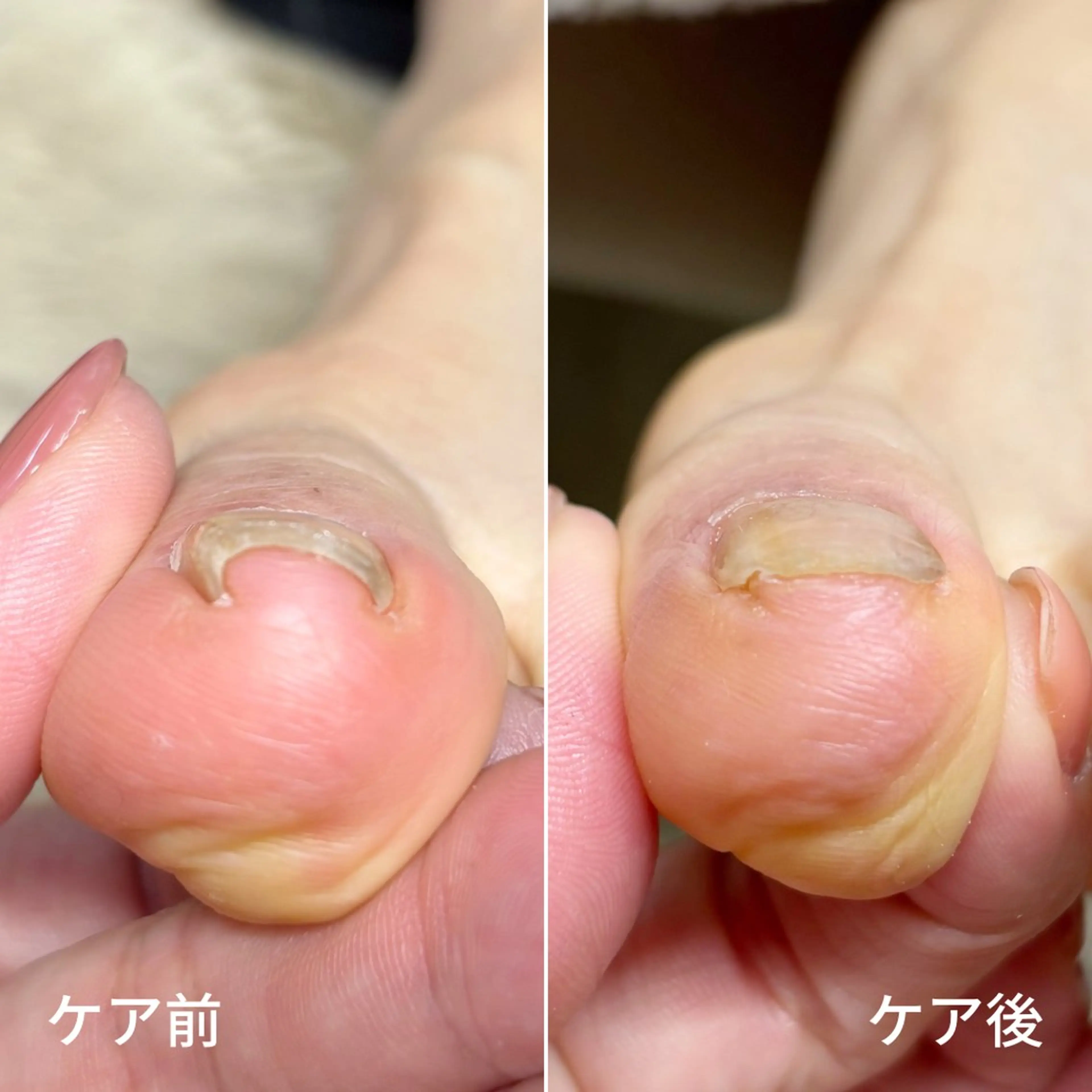 ネイル 深爪・巻き爪 専門サンセリテのネイルデザイン