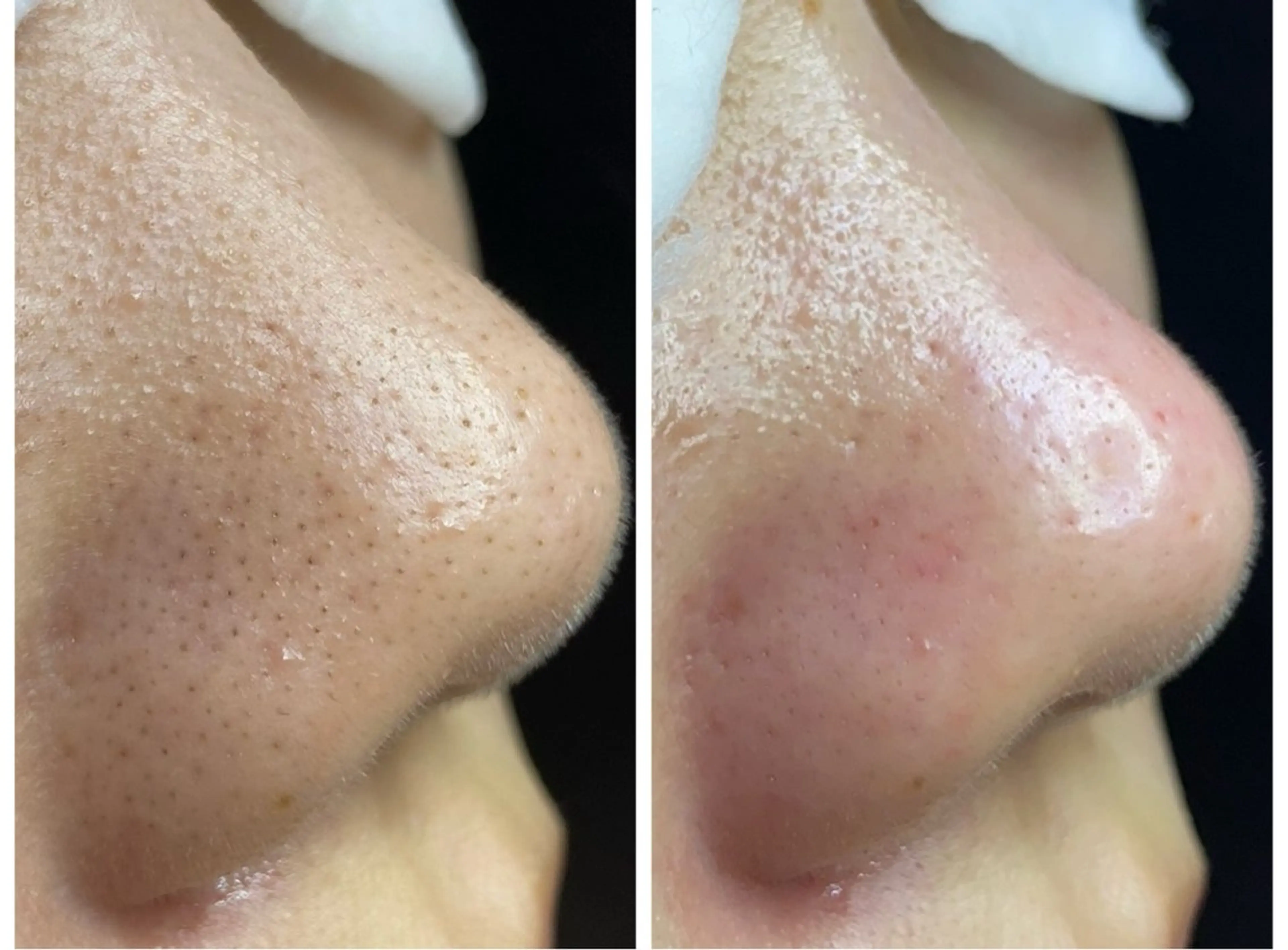 エステ 毛穴専門店RANA所属・毛穴専門店【各務原】 天使の毛穴のエステ・リラクイメージ