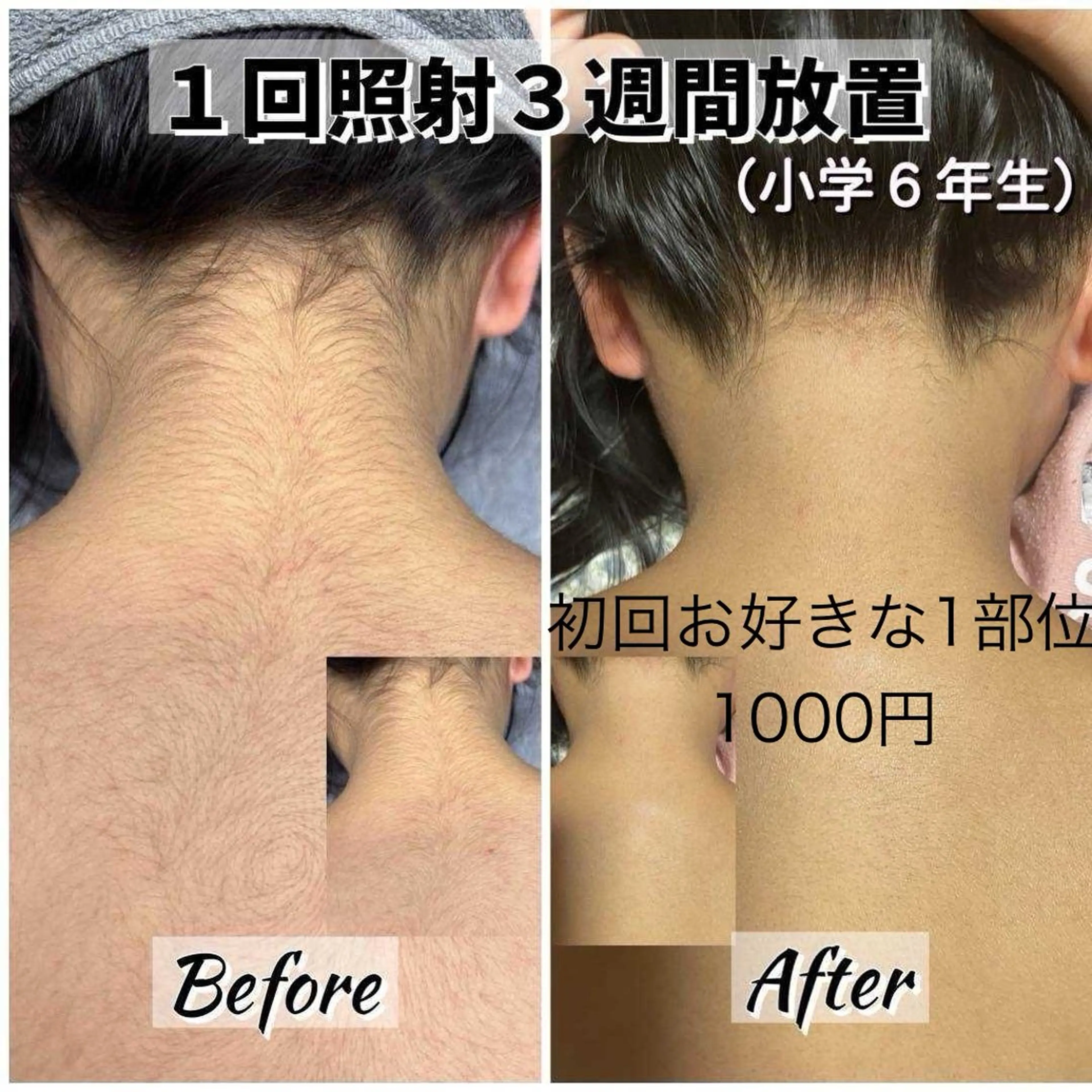 【男女】ジュニア脱毛　一部位　初回キャンペーン　　（高校生まで）　※初回は保護者の方同伴でお願い致します。の写真
