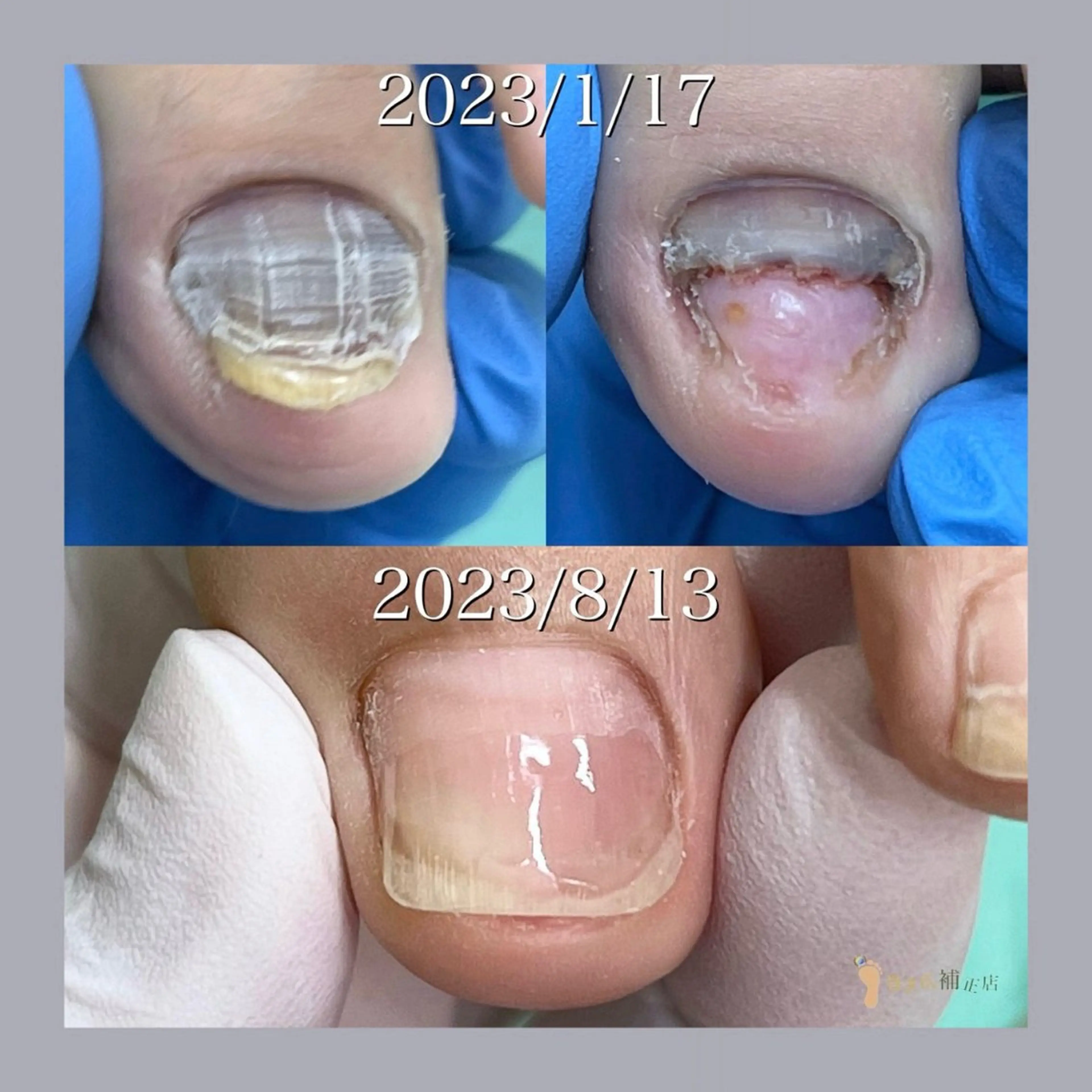 巻き爪補正店 大阪天王寺店のネイルデザイン