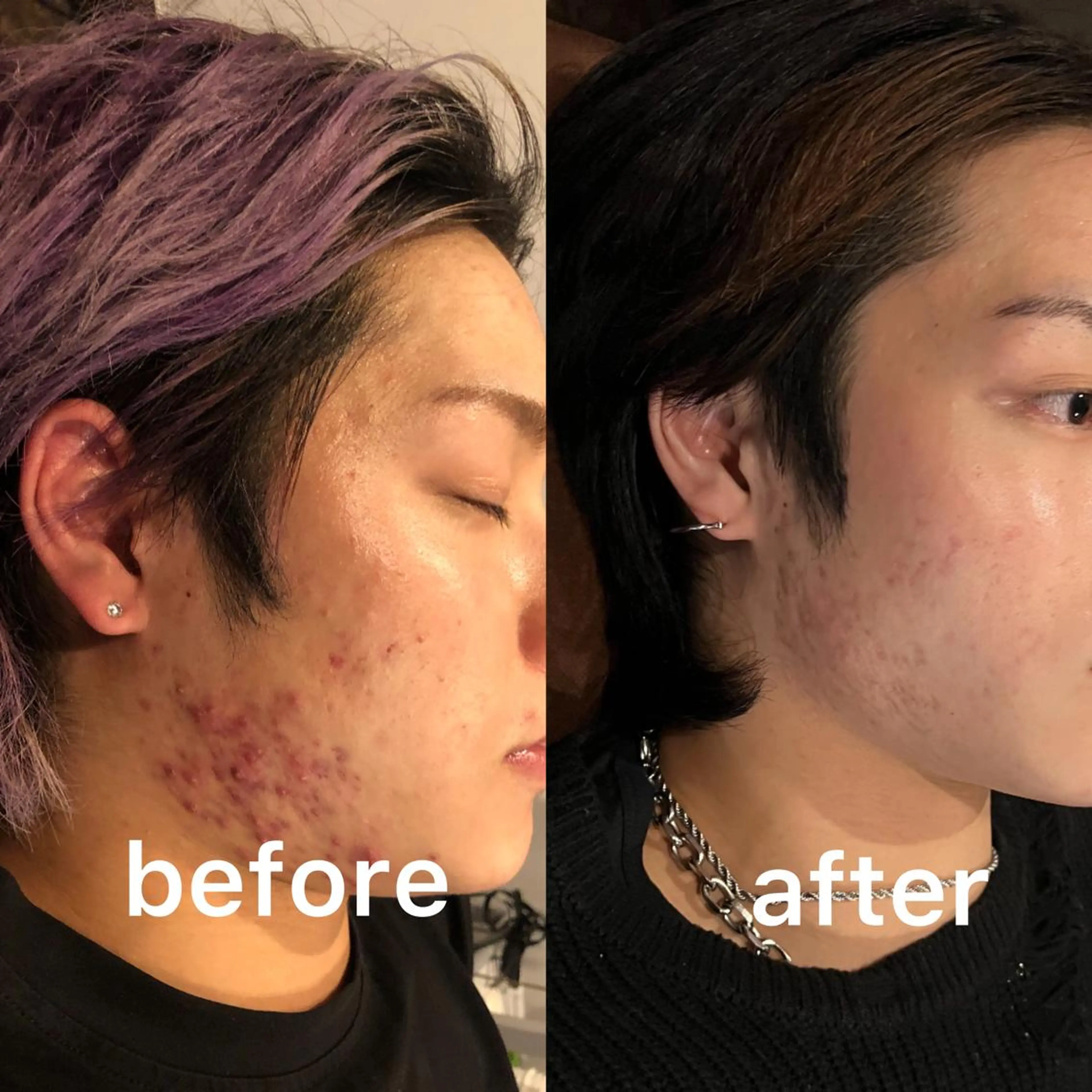 🌟メンズ美容鍼⭐️顔のみの写真