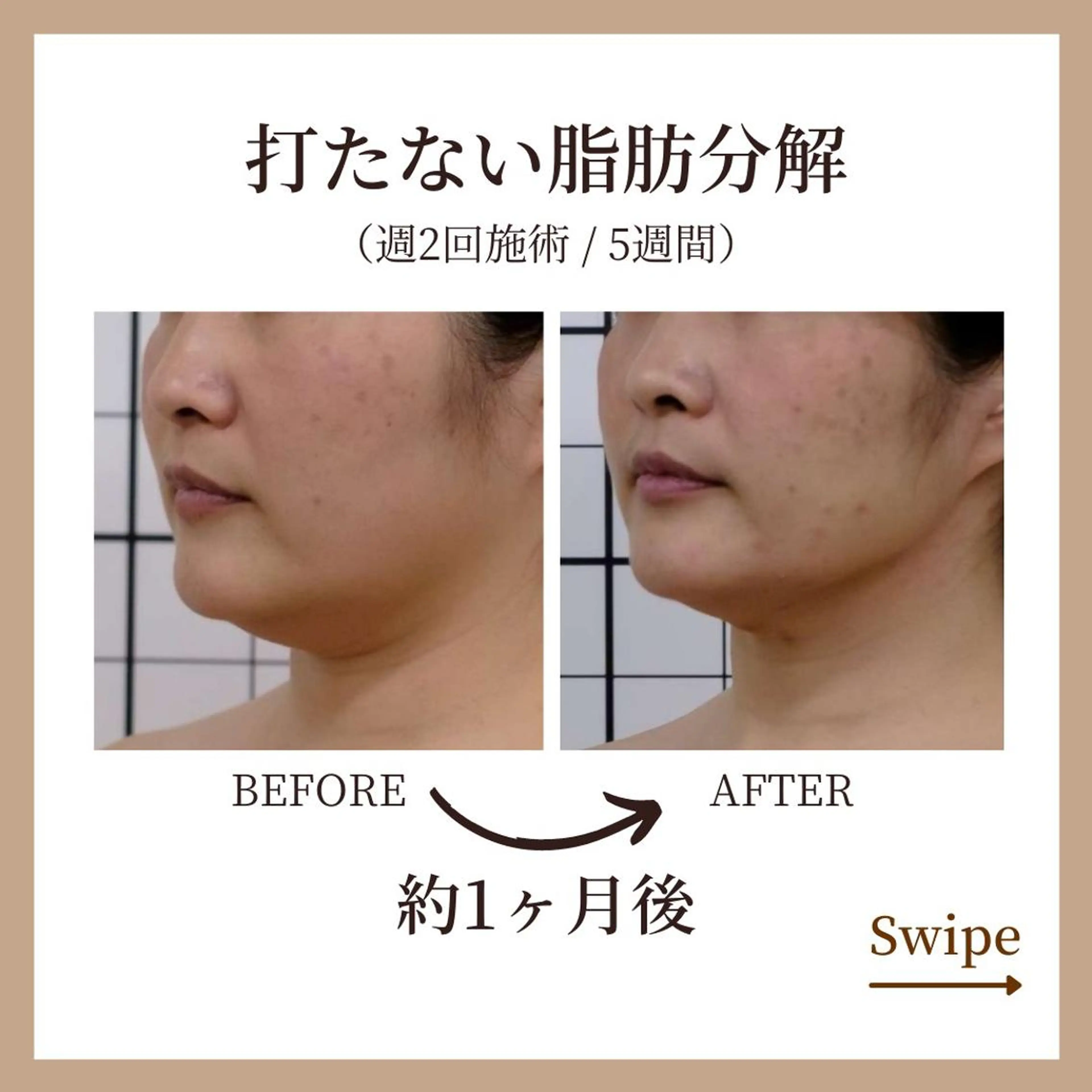 【超絶小顔！！】打たない最新メソセラピー 約30分の写真