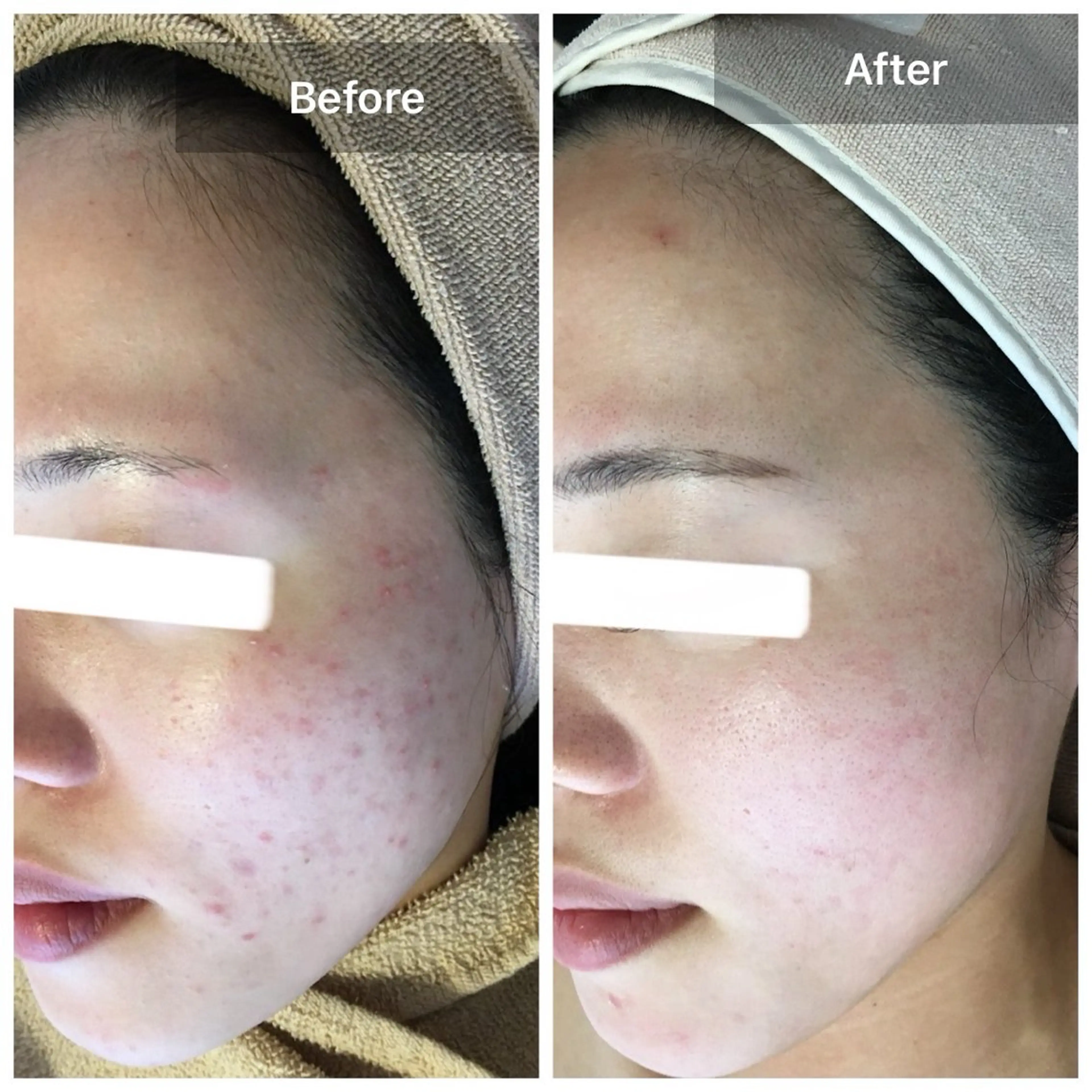 🌿ニキビハーブピーリング✨【剥離ありorなし】【VC美容液】ニキビ/ニキビ跡/黒ずみ/水光肌/毛穴ケア/白ニキビ/角質の写真