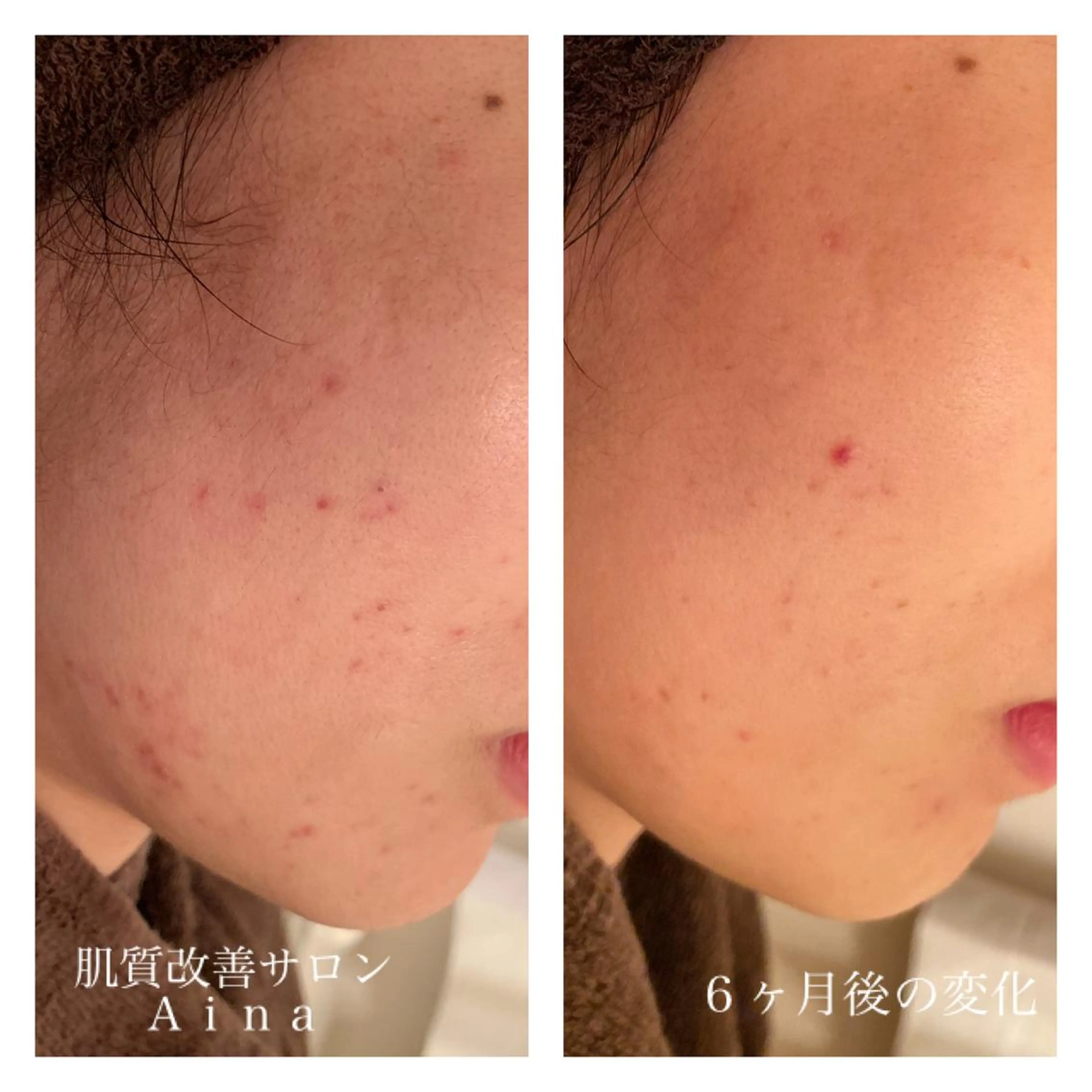 ロング カラー パーマ ヘアアレンジ メンズ キッズ ネイル マツエク・マツパ ニキビ跡専門サロン Ainaのエステ・リラクイメージ