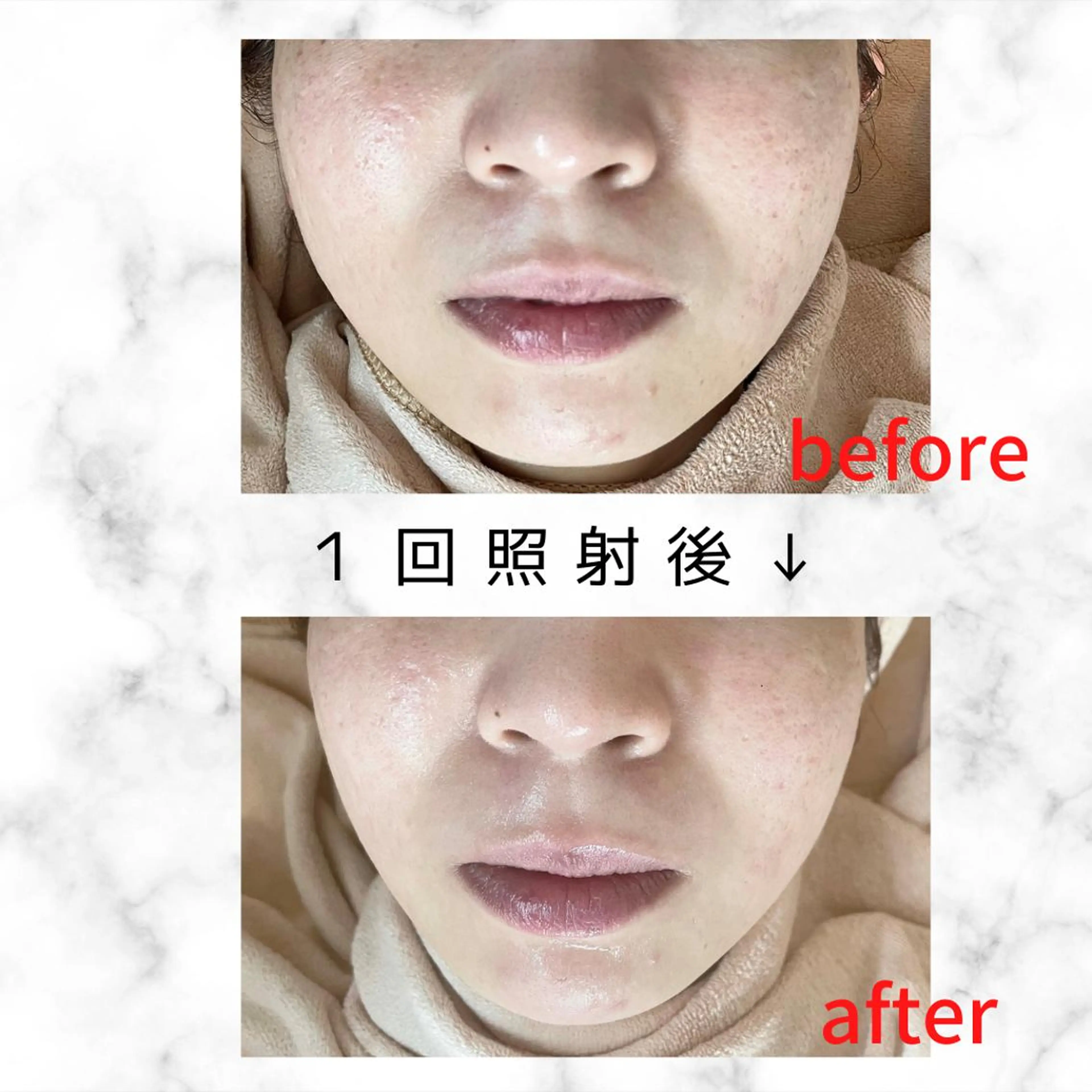 【顔】NPL方式 光フォト〈クレンジング+超音波角質洗浄+光フォト+シートマスク〉光フェイシャル 新規or会員の写真