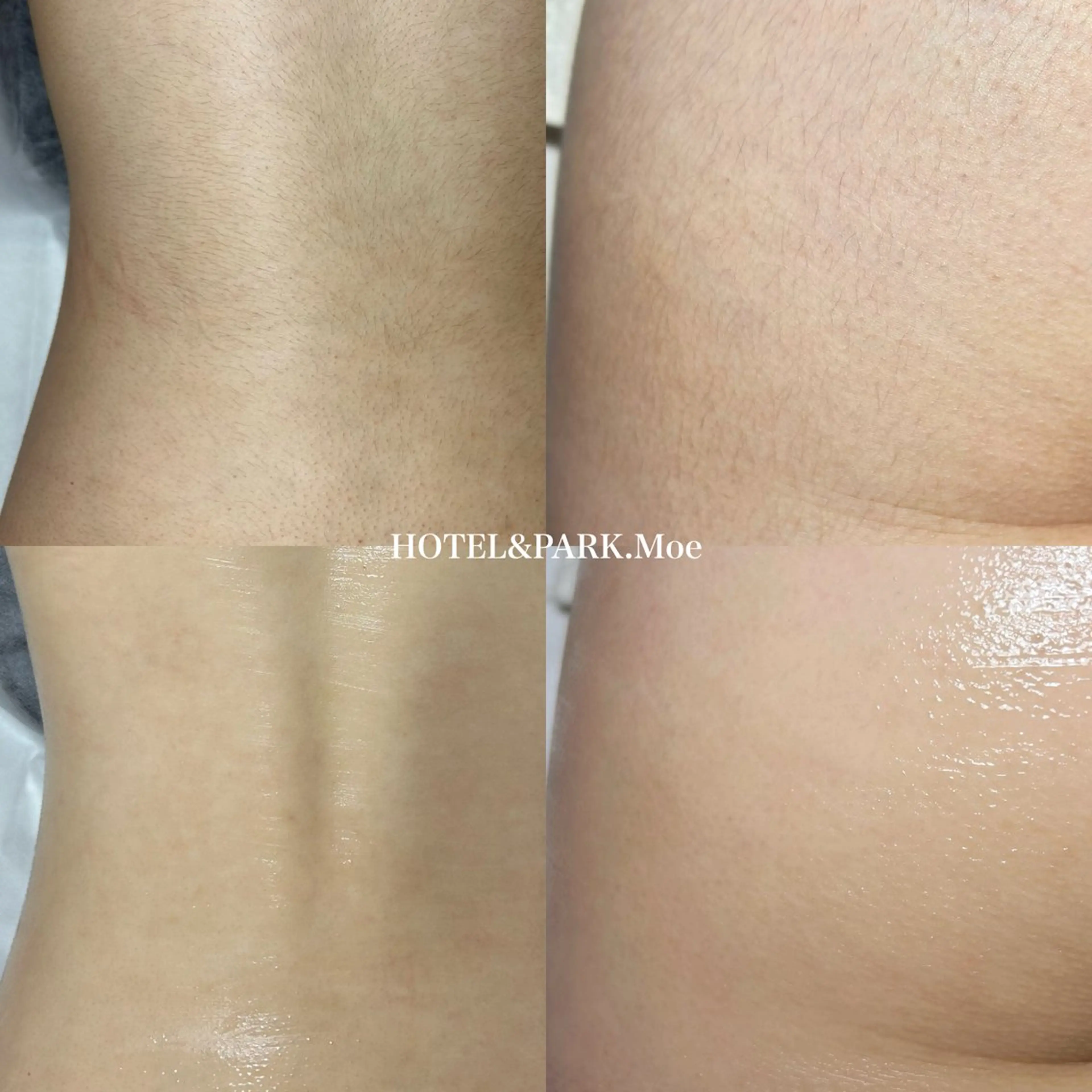 ☃️BIG SALE☃️【背中ALL*うなじ込+ヒップワックス脱毛】の写真