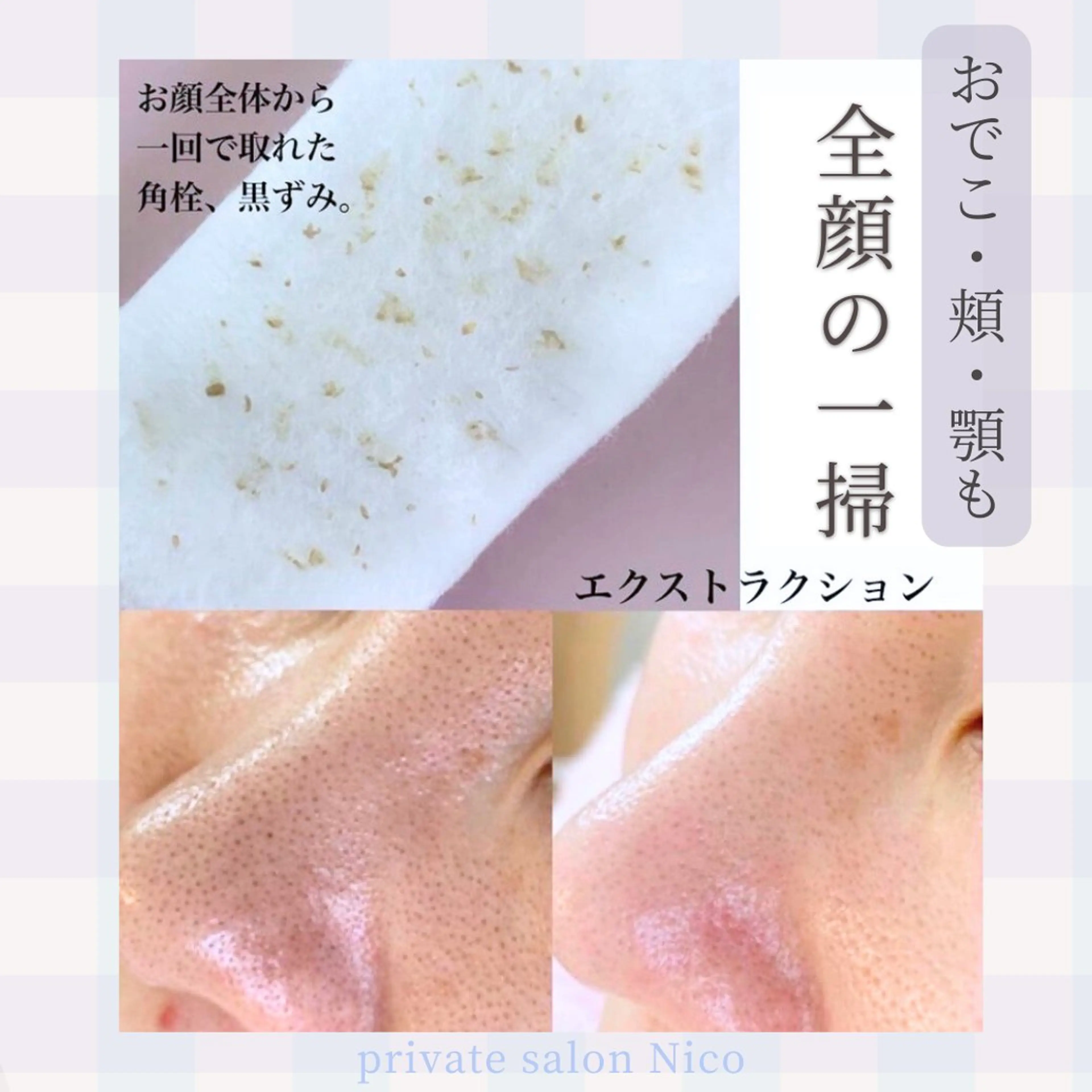 全顔エクストラクション💆‍♀️🌈イチゴ毛穴・ざらつき解消!吸引では取り除けない角栓を手技で丁寧にごっそり大掃除‼︎の写真